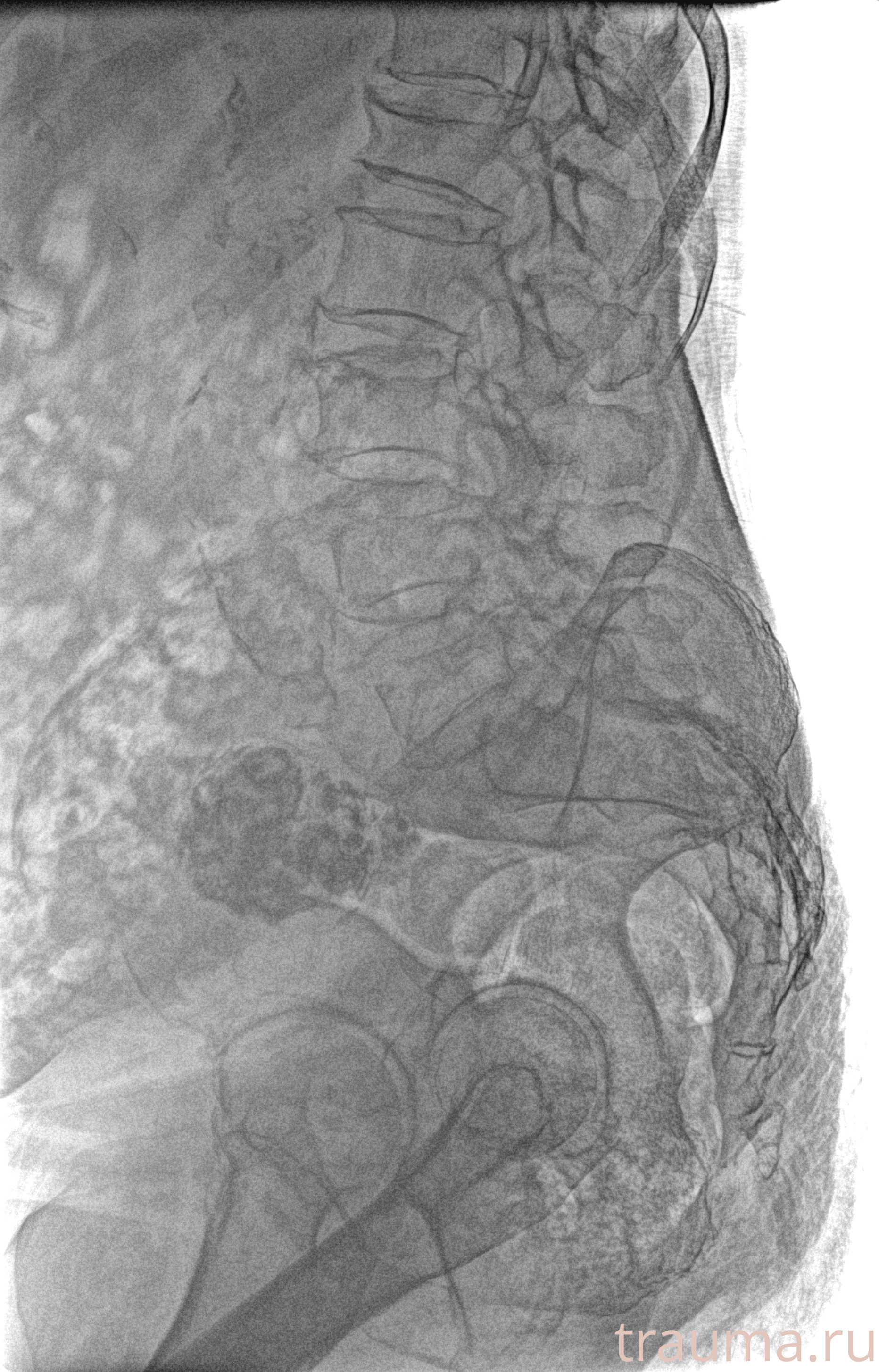 Рентген на дому: по вашему адресу приезжает врач-рентгенолог, травматолог-ортопед с мобильным рентгеновским аппаратом, проводит диагностику травмы или заболевания, делает необходимые рентгенограммы, дает рекомендации по дальнейшему лечению. Получить качественные снимки в домашних условиях возможно благодаря уникальной методике, разработанной МосРентген Центром для института  Склифосовского