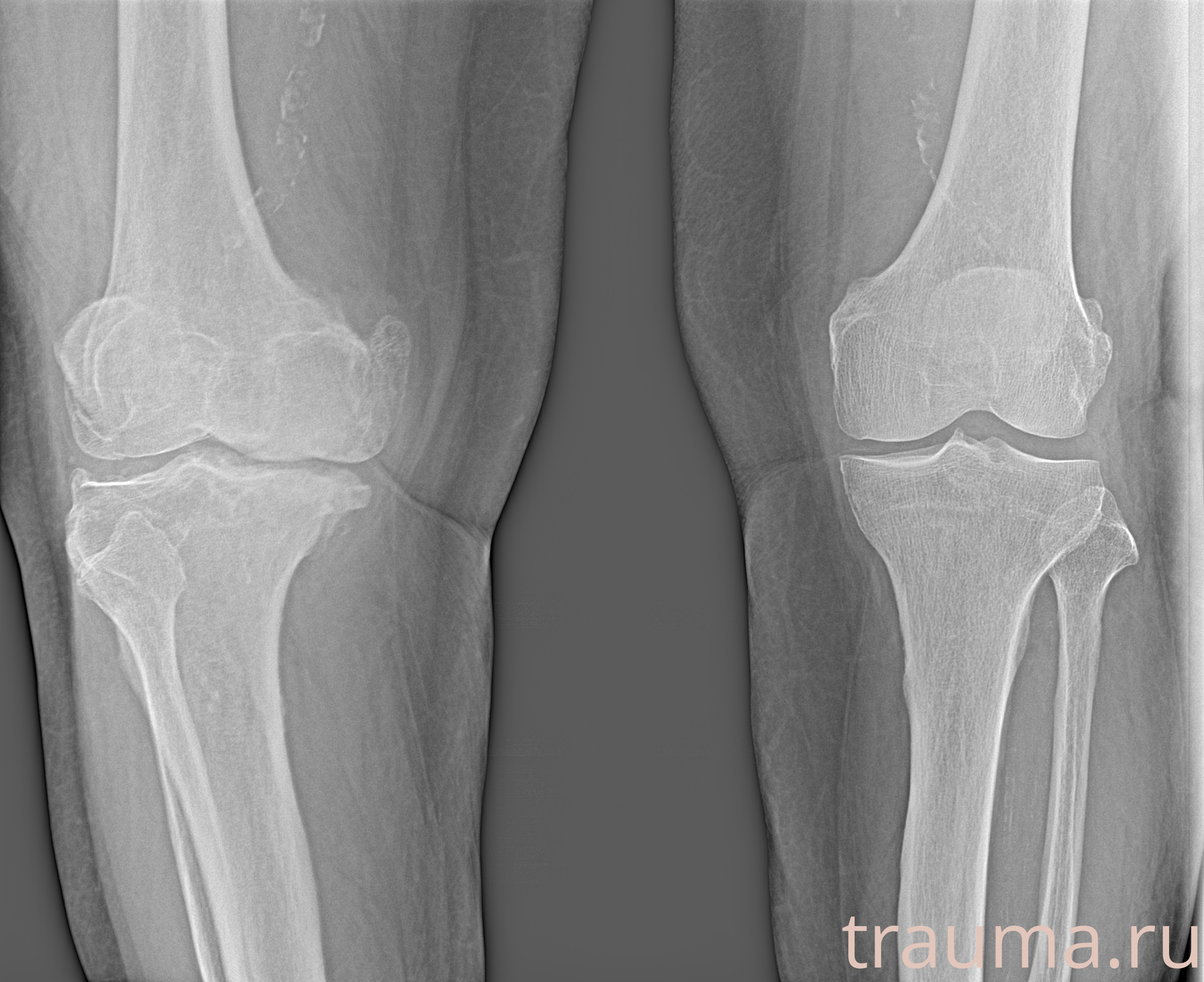 Рентген на дому: по вашему адресу приезжает врач-рентгенолог, травматолог-ортопед с мобильным рентгеновским аппаратом, проводит диагностику травмы или заболевания, делает необходимые рентгенограммы, дает рекомендации по дальнейшему лечению. Получить качественные снимки в домашних условиях возможно благодаря уникальной методике, разработанной МосРентген Центром для института  Склифосовского