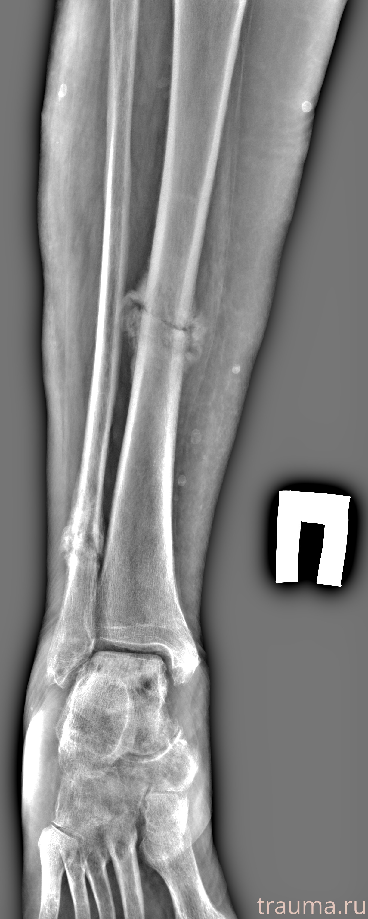 Рентген на дому: по вашему адресу приезжает врач-рентгенолог, травматолог-ортопед с мобильным рентгеновским аппаратом, проводит диагностику травмы или заболевания, делает необходимые рентгенограммы, дает рекомендации по дальнейшему лечению. Получить качественные снимки в домашних условиях возможно благодаря уникальной методике, разработанной МосРентген Центром для института  Склифосовского