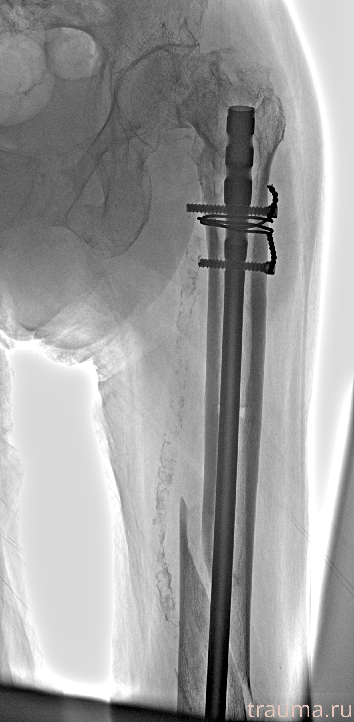 Рентген на дому: по вашему адресу приезжает врач-рентгенолог, травматолог-ортопед с мобильным рентгеновским аппаратом, проводит диагностику травмы или заболевания, делает необходимые рентгенограммы, дает рекомендации по дальнейшему лечению. Получить качественные снимки в домашних условиях возможно благодаря уникальной методике, разработанной МосРентген Центром для института  Склифосовского