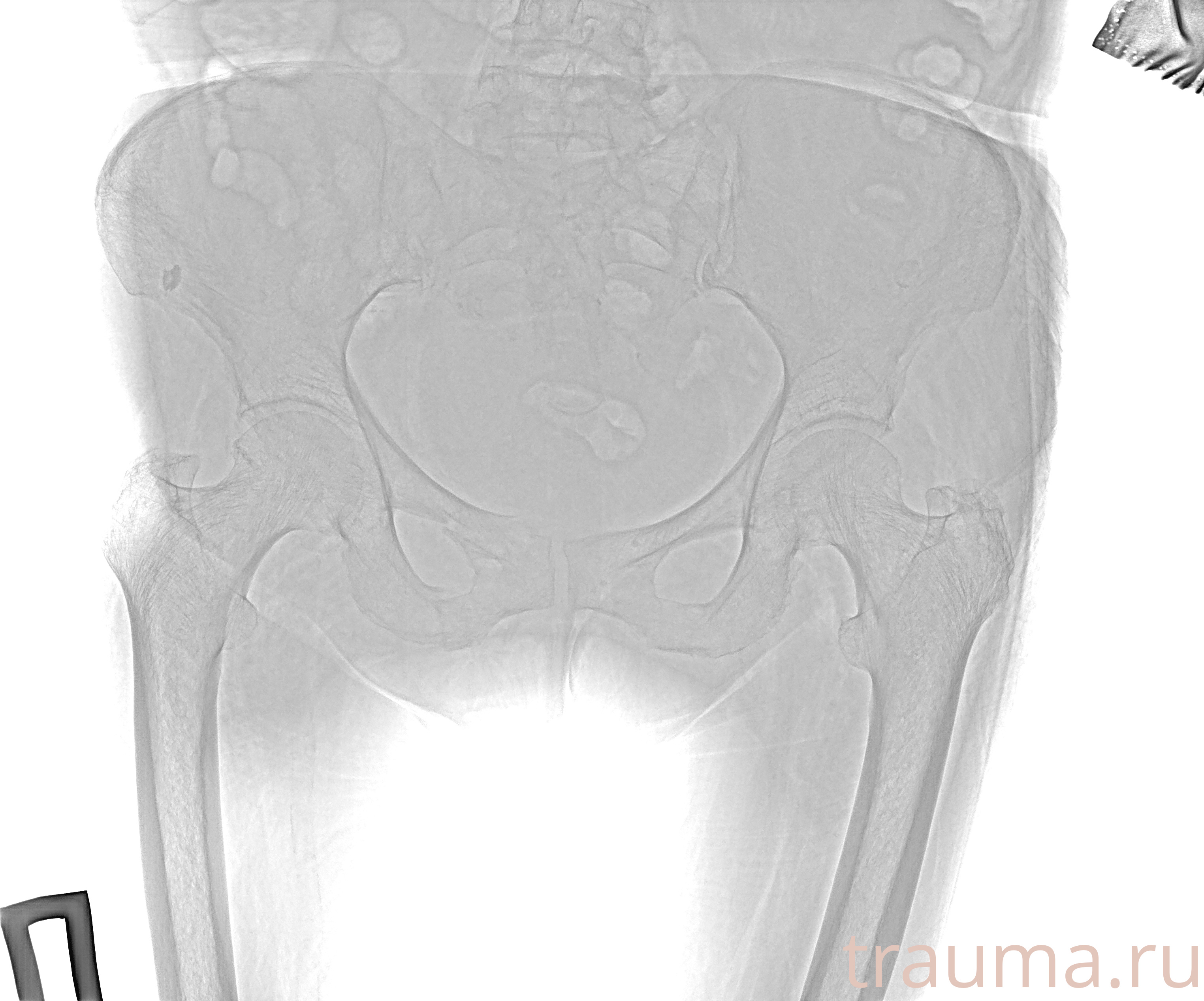 Рентген на дому: по вашему адресу приезжает врач-рентгенолог, травматолог-ортопед с мобильным рентгеновским аппаратом, проводит диагностику травмы или заболевания, делает необходимые рентгенограммы, дает рекомендации по дальнейшему лечению. Получить качественные снимки в домашних условиях возможно благодаря уникальной методике, разработанной МосРентген Центром для института  Склифосовского