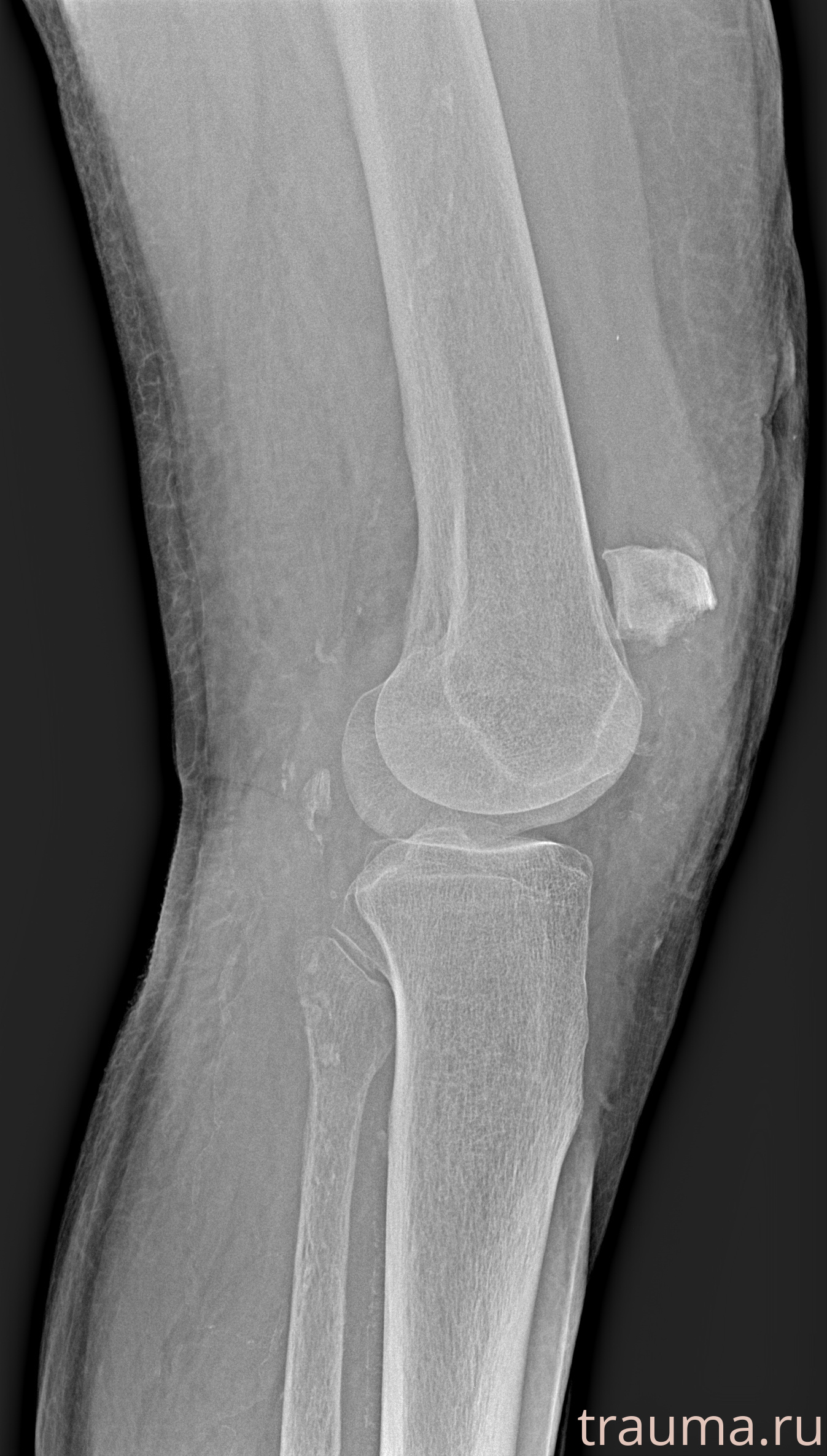 Рентген на дому: по вашему адресу приезжает врач-рентгенолог, травматолог-ортопед с мобильным рентгеновским аппаратом, проводит диагностику травмы или заболевания, делает необходимые рентгенограммы, дает рекомендации по дальнейшему лечению. Получить качественные снимки в домашних условиях возможно благодаря уникальной методике, разработанной МосРентген Центром для института  Склифосовского