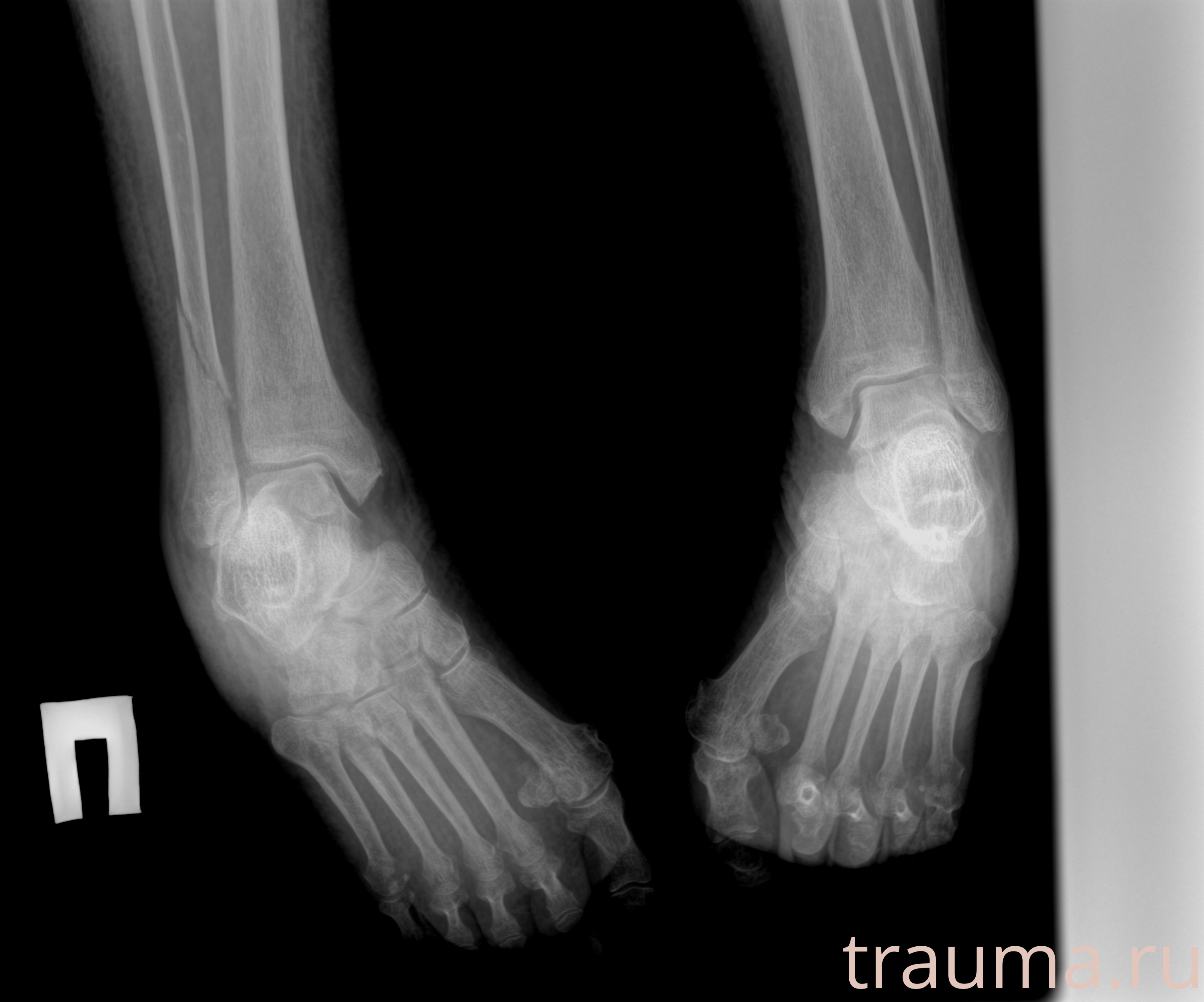 Рентген на дому: по вашему адресу приезжает врач-рентгенолог, травматолог-ортопед с мобильным рентгеновским аппаратом, проводит диагностику травмы или заболевания, делает необходимые рентгенограммы, дает рекомендации по дальнейшему лечению. Получить качественные снимки в домашних условиях возможно благодаря уникальной методике, разработанной МосРентген Центром для института  Склифосовского