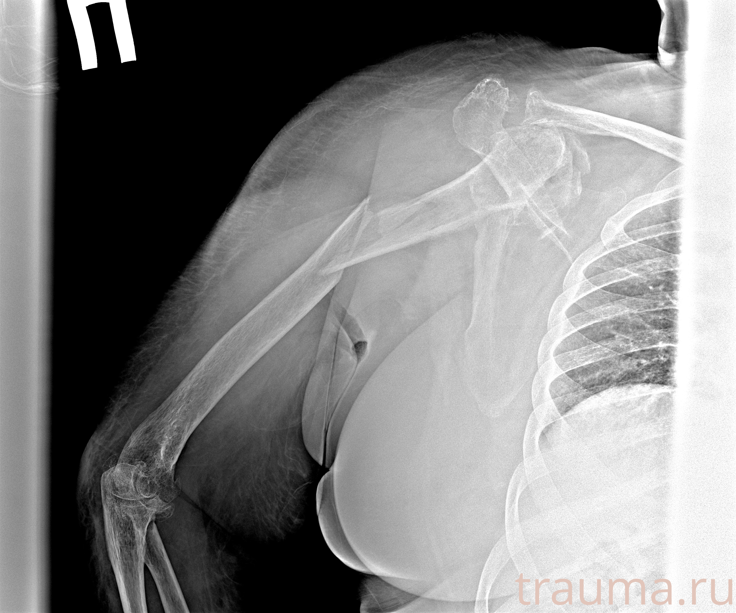 Рентген на дому: по вашему адресу приезжает врач-рентгенолог, травматолог-ортопед с мобильным рентгеновским аппаратом, проводит диагностику травмы или заболевания, делает необходимые рентгенограммы, дает рекомендации по дальнейшему лечению. Получить качественные снимки в домашних условиях возможно благодаря уникальной методике, разработанной МосРентген Центром для института  Склифосовского