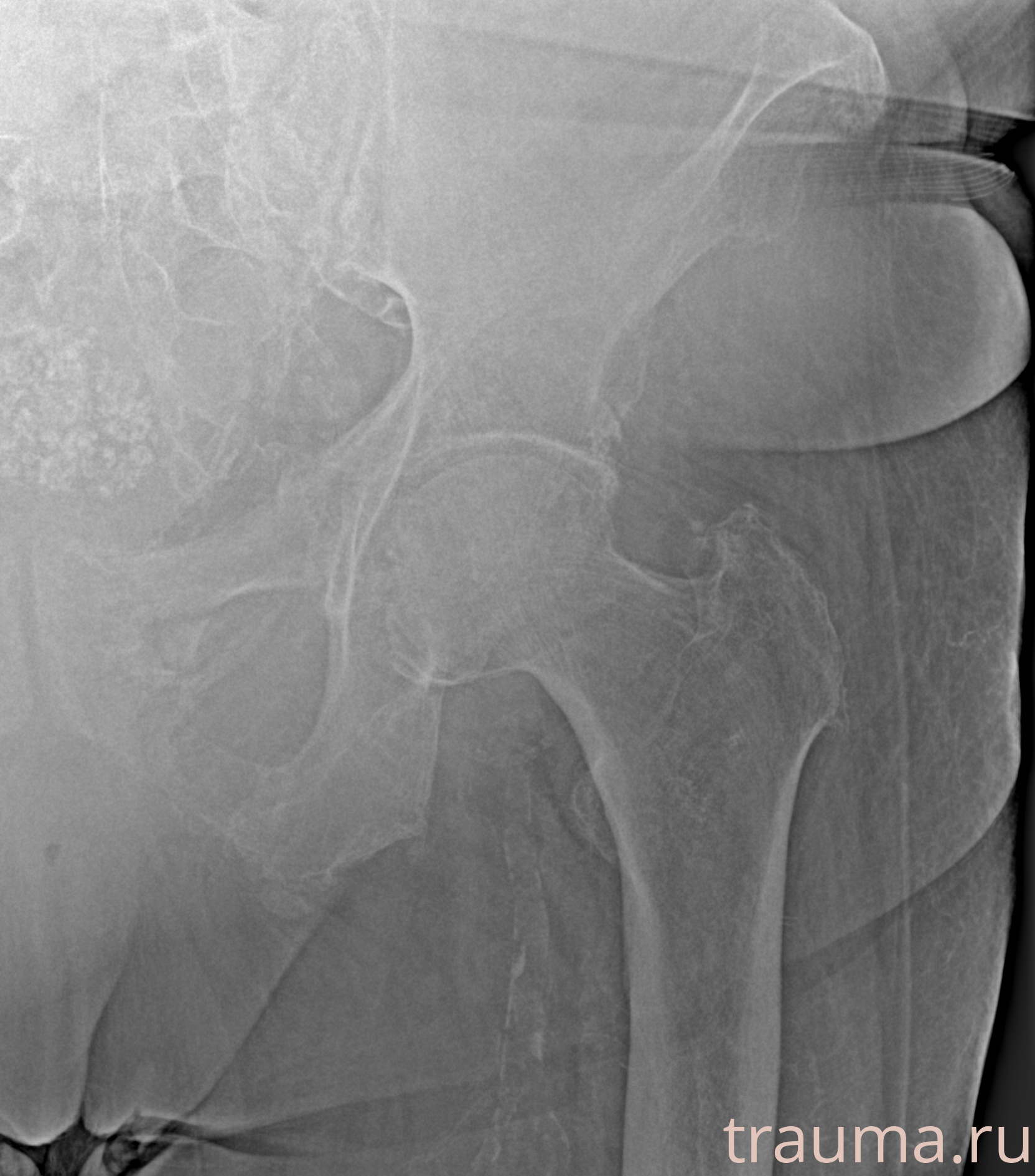 Рентген на дому: по вашему адресу приезжает врач-рентгенолог, травматолог-ортопед с мобильным рентгеновским аппаратом, проводит диагностику травмы или заболевания, делает необходимые рентгенограммы, дает рекомендации по дальнейшему лечению. Получить качественные снимки в домашних условиях возможно благодаря уникальной методике, разработанной МосРентген Центром для института  Склифосовского