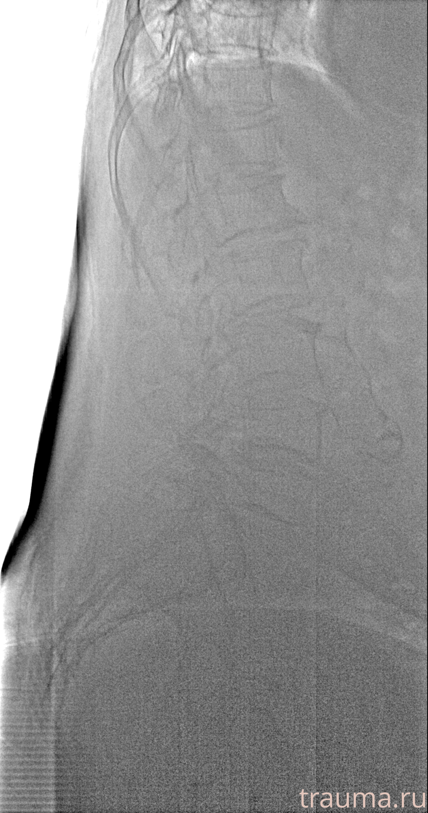 Рентген на дому: по вашему адресу приезжает врач-рентгенолог, травматолог-ортопед с мобильным рентгеновским аппаратом, проводит диагностику травмы или заболевания, делает необходимые рентгенограммы, дает рекомендации по дальнейшему лечению. Получить качественные снимки в домашних условиях возможно благодаря уникальной методике, разработанной МосРентген Центром для института  Склифосовского