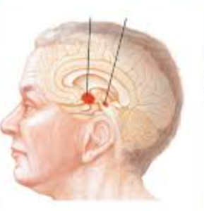 Новые технологии в диагностике двигательных нарушений: оценка гипокинезии при болезни Паркинсона