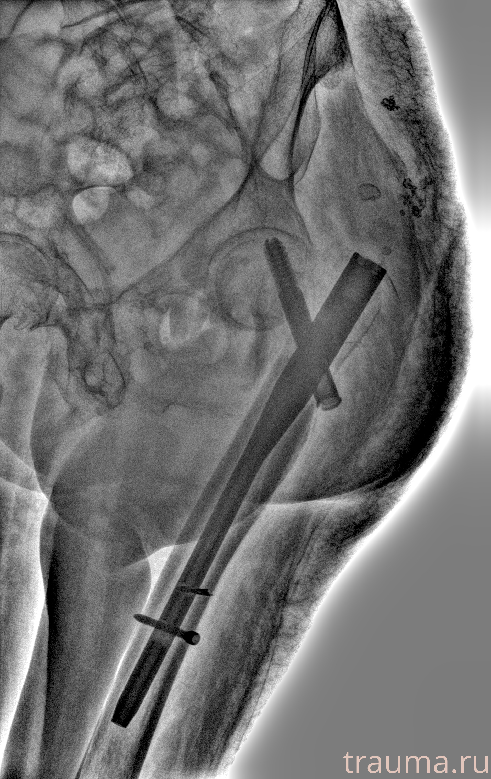 Рентген на дому: по вашему адресу приезжает врач-рентгенолог, травматолог-ортопед с мобильным рентгеновским аппаратом, проводит диагностику травмы или заболевания, делает необходимые рентгенограммы, дает рекомендации по дальнейшему лечению. Получить качественные снимки в домашних условиях возможно благодаря уникальной методике, разработанной МосРентген Центром для института  Склифосовского