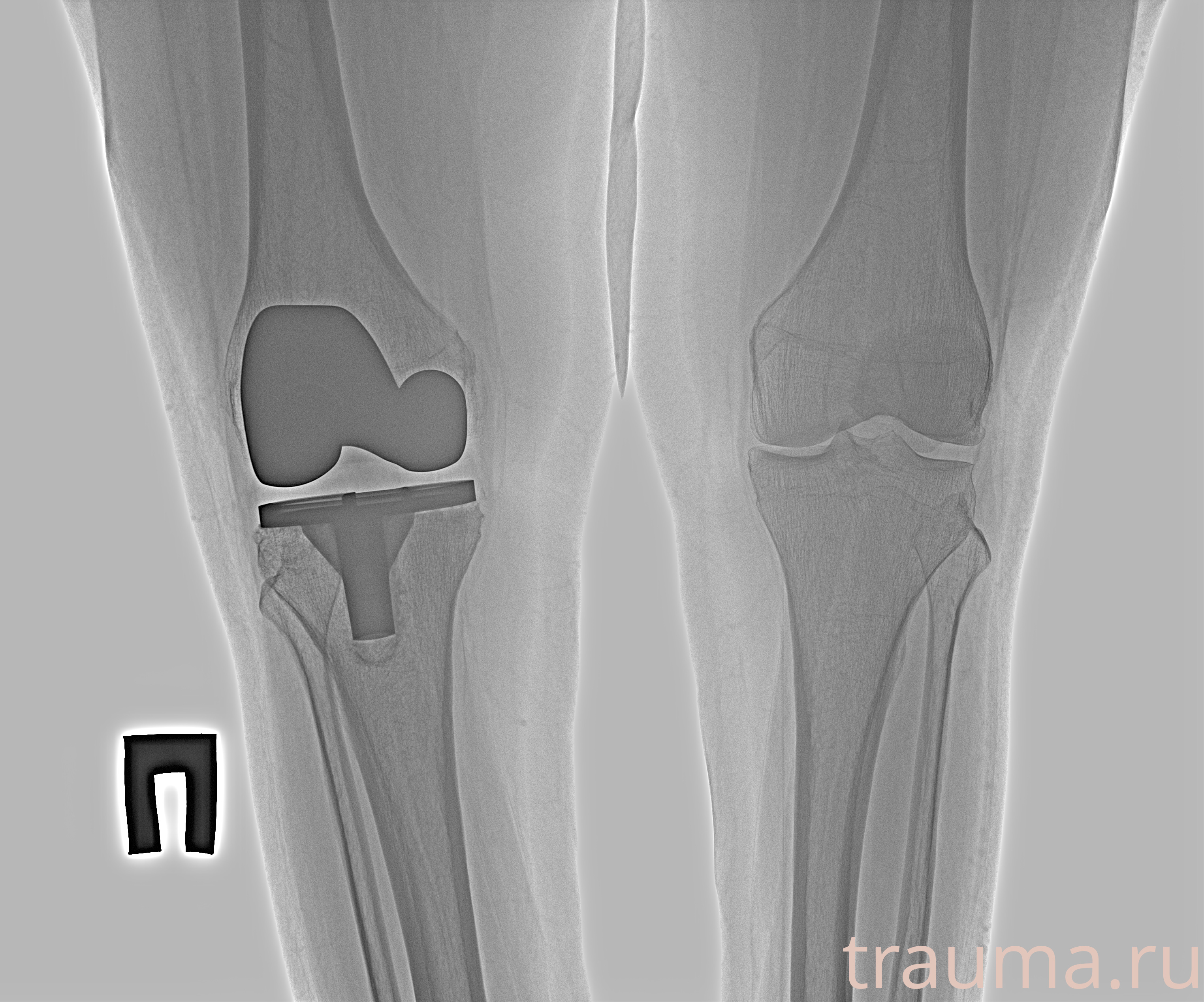 Рентген на дому: по вашему адресу приезжает врач-рентгенолог, травматолог-ортопед с мобильным рентгеновским аппаратом, проводит диагностику травмы или заболевания, делает необходимые рентгенограммы, дает рекомендации по дальнейшему лечению. Получить качественные снимки в домашних условиях возможно благодаря уникальной методике, разработанной МосРентген Центром для института  Склифосовского