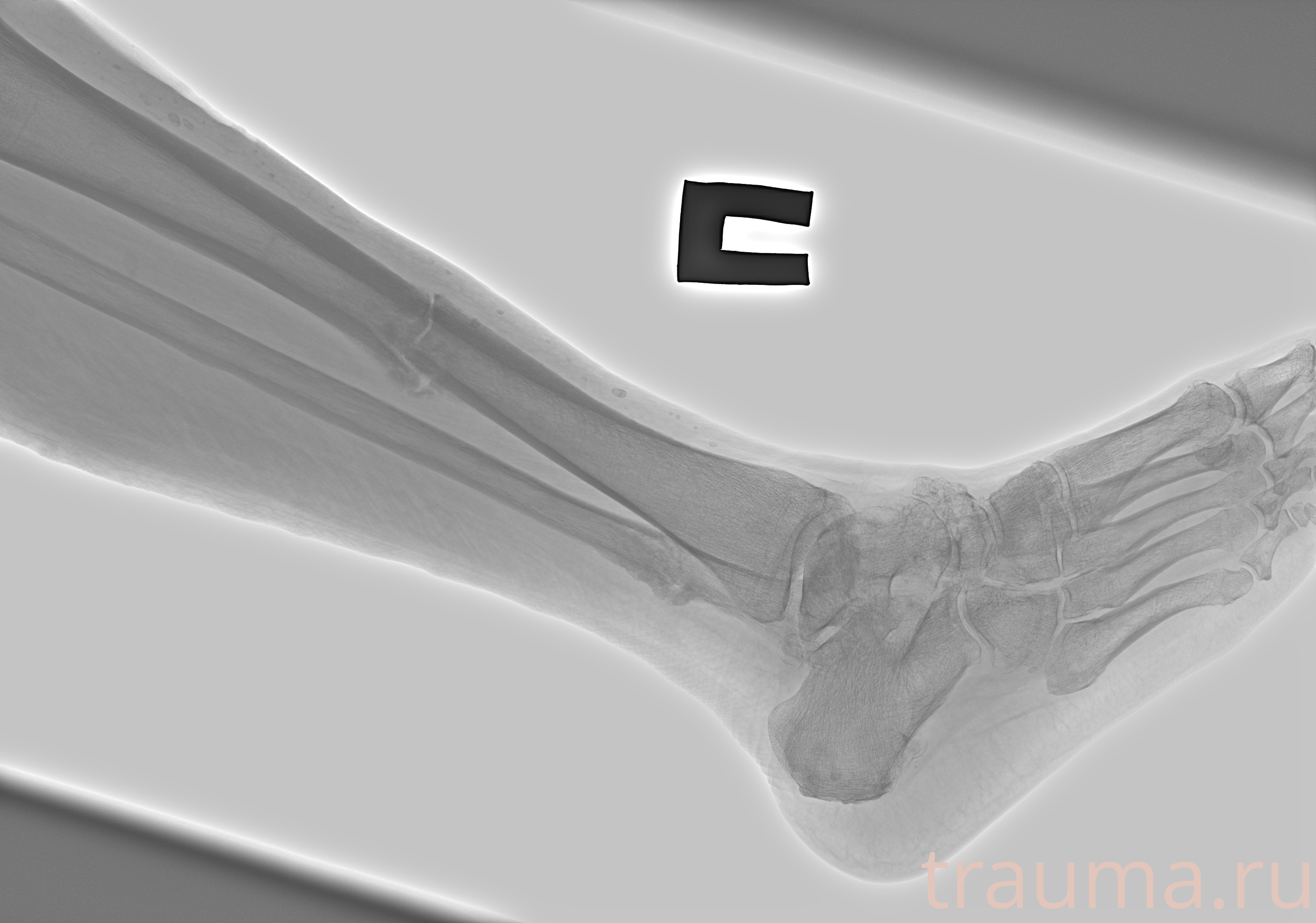 Рентген на дому: по вашему адресу приезжает врач-рентгенолог, травматолог-ортопед с мобильным рентгеновским аппаратом, проводит диагностику травмы или заболевания, делает необходимые рентгенограммы, дает рекомендации по дальнейшему лечению. Получить качественные снимки в домашних условиях возможно благодаря уникальной методике, разработанной МосРентген Центром для института  Склифосовского