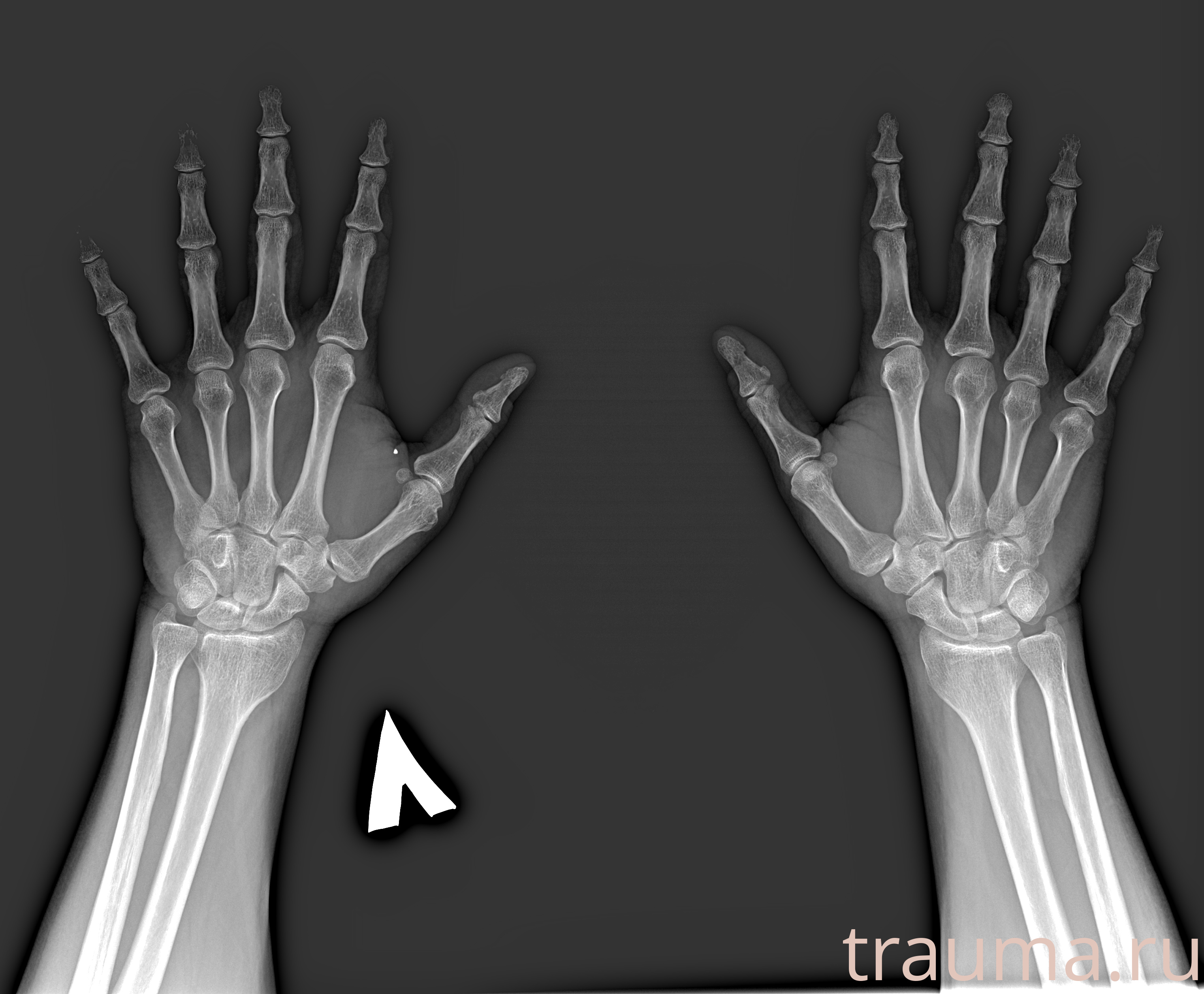 Рентген на дому: по вашему адресу приезжает врач-рентгенолог, травматолог-ортопед с мобильным рентгеновским аппаратом, проводит диагностику травмы или заболевания, делает необходимые рентгенограммы, дает рекомендации по дальнейшему лечению. Получить качественные снимки в домашних условиях возможно благодаря уникальной методике, разработанной МосРентген Центром для института  Склифосовского