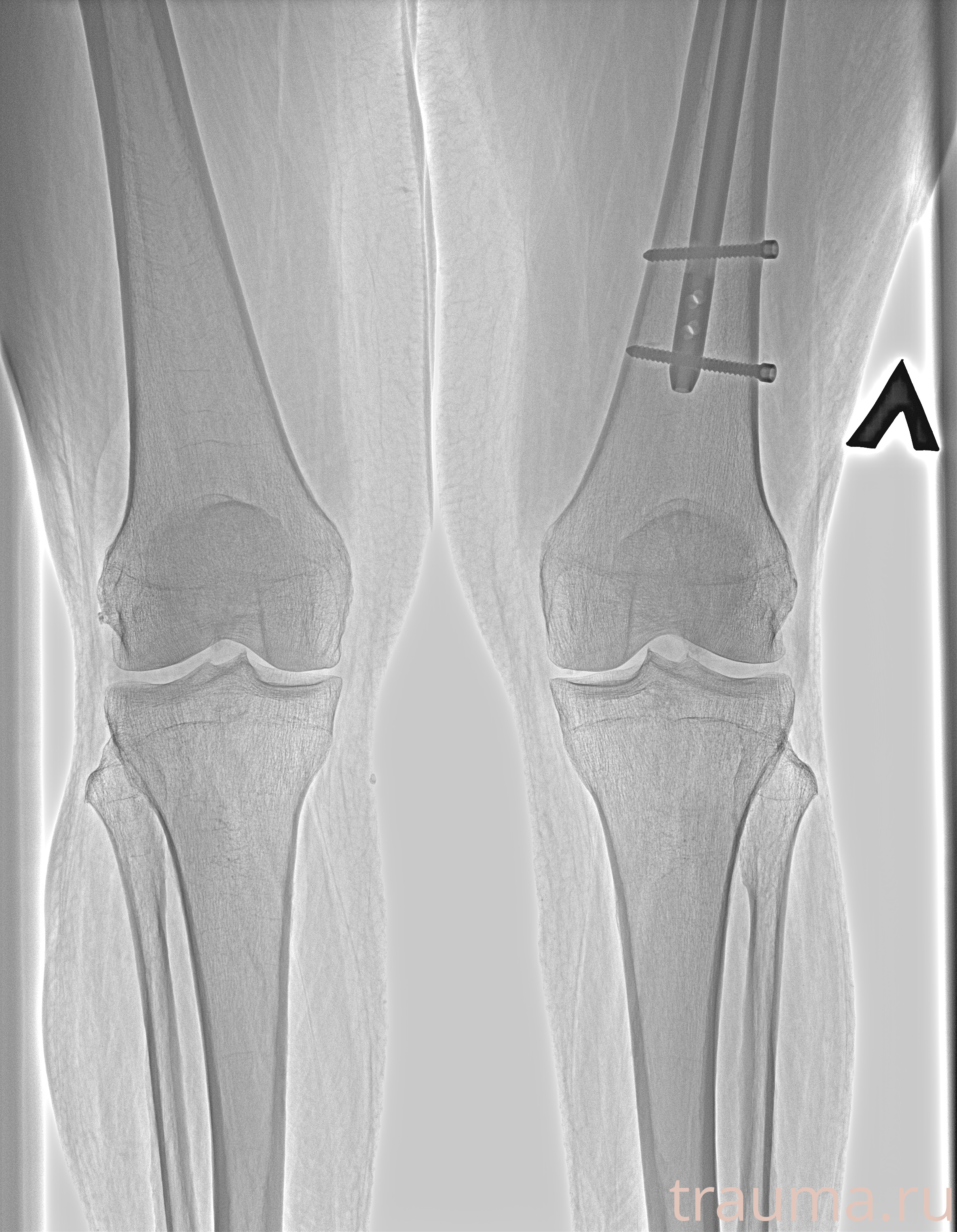 Рентген на дому: по вашему адресу приезжает врач-рентгенолог, травматолог-ортопед с мобильным рентгеновским аппаратом, проводит диагностику травмы или заболевания, делает необходимые рентгенограммы, дает рекомендации по дальнейшему лечению. Получить качественные снимки в домашних условиях возможно благодаря уникальной методике, разработанной МосРентген Центром для института  Склифосовского