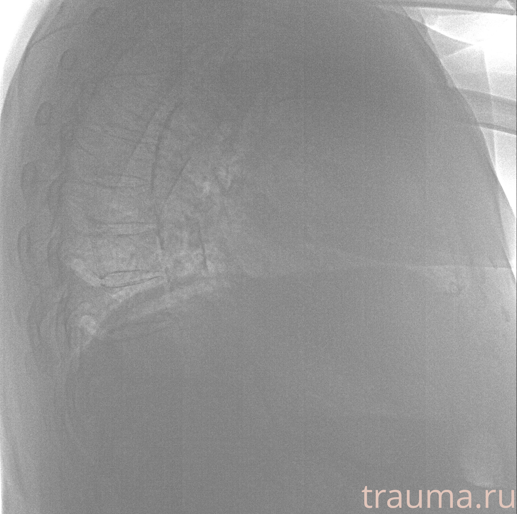 Рентген на дому: по вашему адресу приезжает врач-рентгенолог, травматолог-ортопед с мобильным рентгеновским аппаратом, проводит диагностику травмы или заболевания, делает необходимые рентгенограммы, дает рекомендации по дальнейшему лечению. Получить качественные снимки в домашних условиях возможно благодаря уникальной методике, разработанной МосРентген Центром для института  Склифосовского