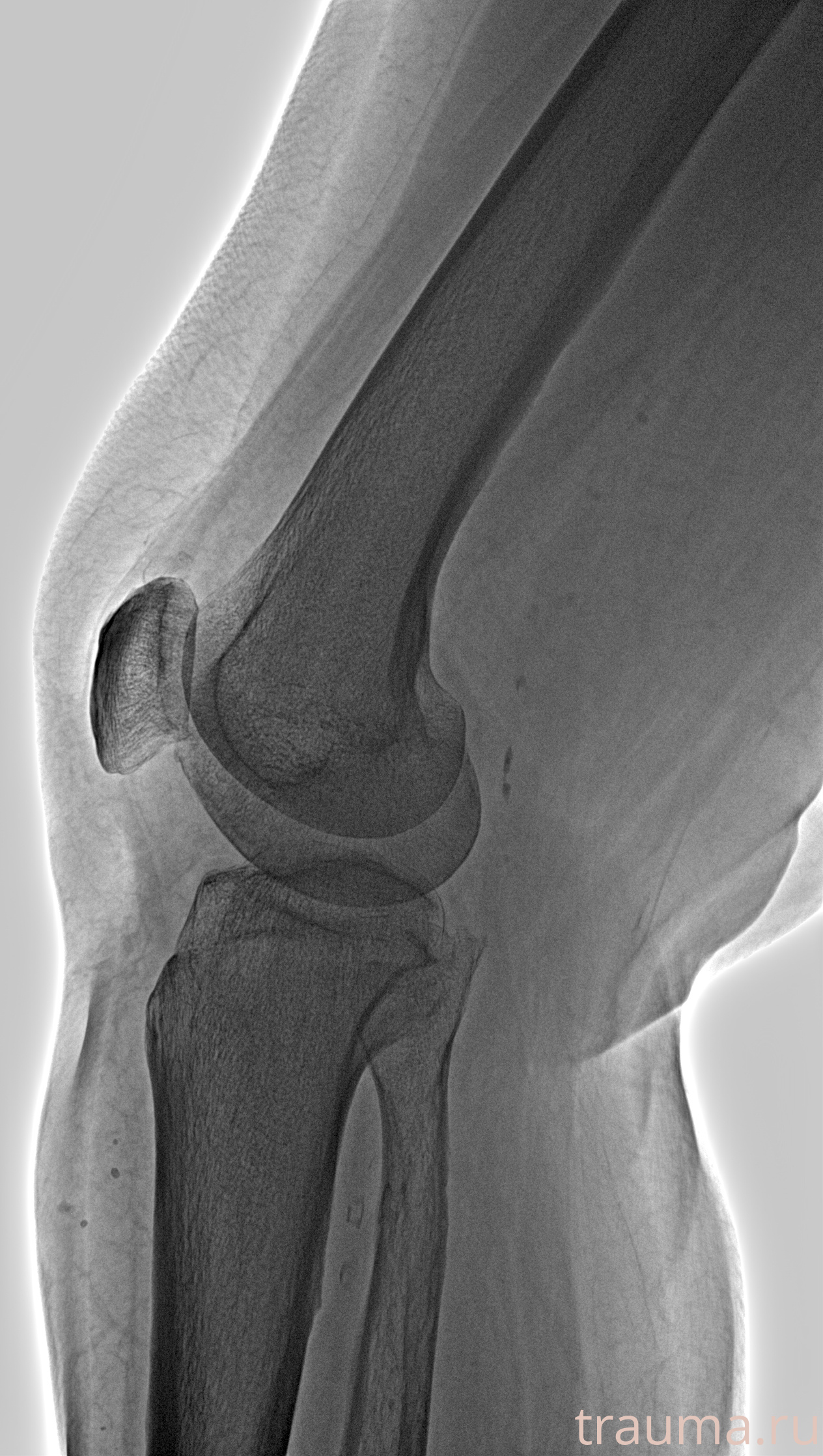 Рентген на дому: по вашему адресу приезжает врач-рентгенолог, травматолог-ортопед с мобильным рентгеновским аппаратом, проводит диагностику травмы или заболевания, делает необходимые рентгенограммы, дает рекомендации по дальнейшему лечению. Получить качественные снимки в домашних условиях возможно благодаря уникальной методике, разработанной МосРентген Центром для института  Склифосовского