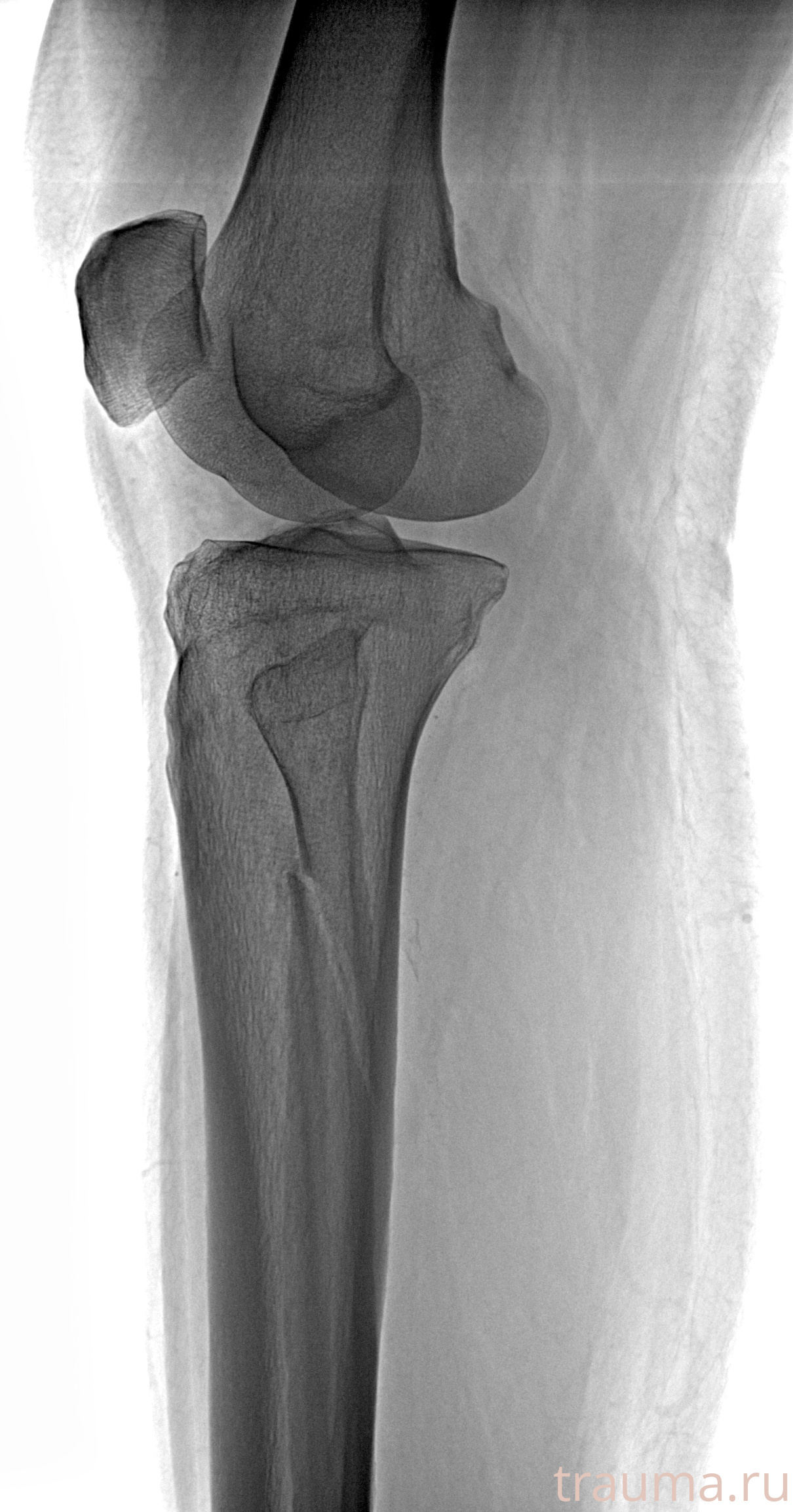 Рентген на дому: по вашему адресу приезжает врач-рентгенолог, травматолог-ортопед с мобильным рентгеновским аппаратом, проводит диагностику травмы или заболевания, делает необходимые рентгенограммы, дает рекомендации по дальнейшему лечению. Получить качественные снимки в домашних условиях возможно благодаря уникальной методике, разработанной МосРентген Центром для института  Склифосовского