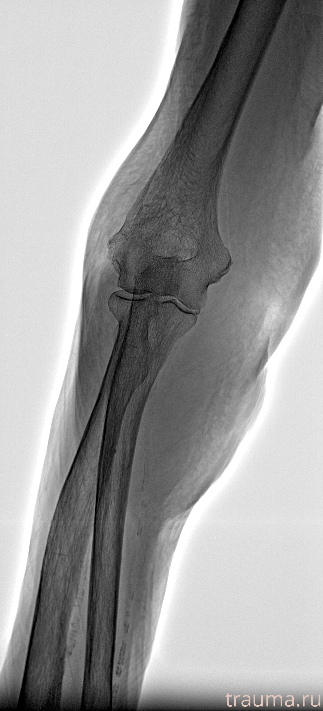 Рентген на дому: по вашему адресу приезжает врач-рентгенолог, травматолог-ортопед с мобильным рентгеновским аппаратом, проводит диагностику травмы или заболевания, делает необходимые рентгенограммы, дает рекомендации по дальнейшему лечению. Получить качественные снимки в домашних условиях возможно благодаря уникальной методике, разработанной МосРентген Центром для института  Склифосовского