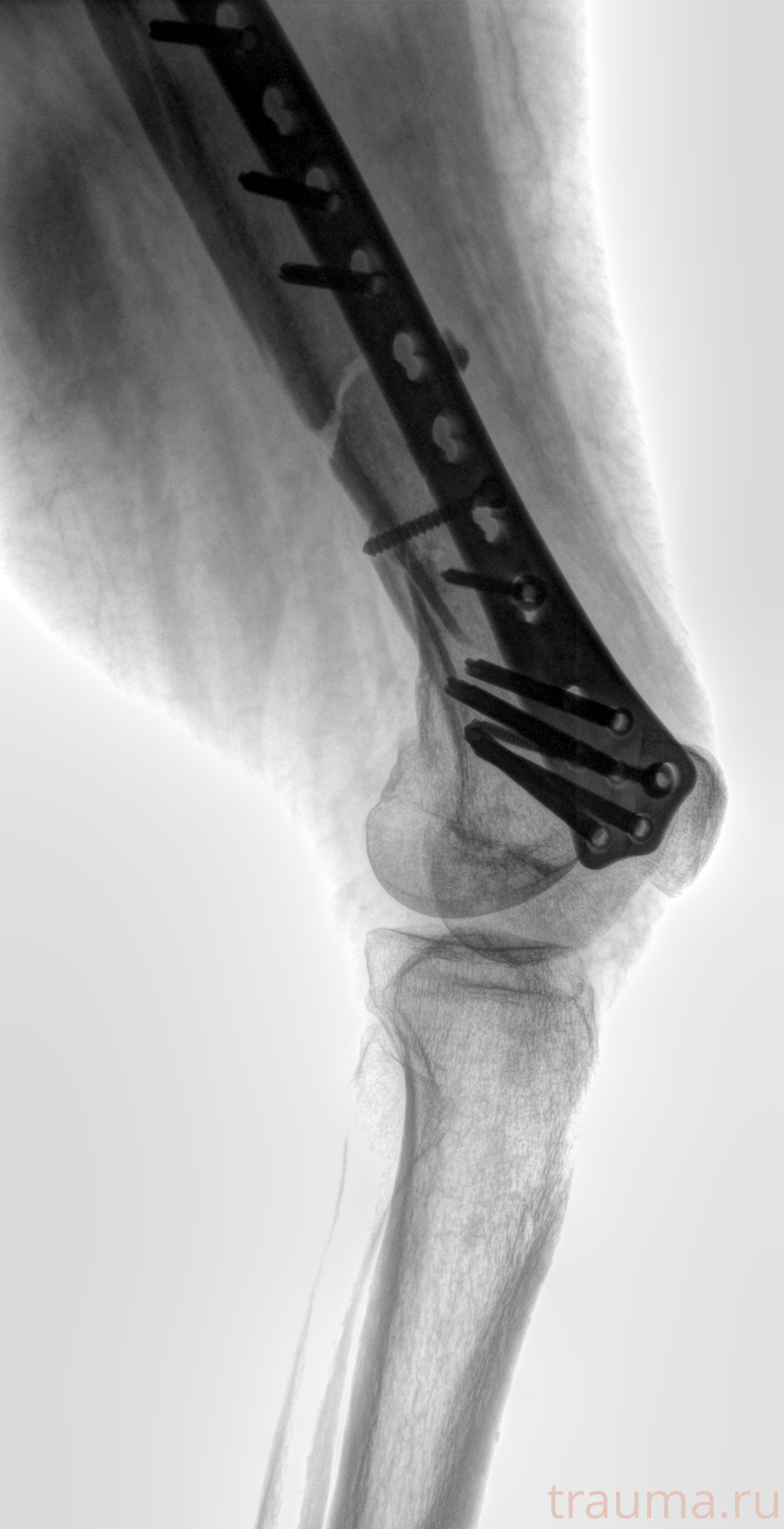 Рентген на дому: по вашему адресу приезжает врач-рентгенолог, травматолог-ортопед с мобильным рентгеновским аппаратом, проводит диагностику травмы или заболевания, делает необходимые рентгенограммы, дает рекомендации по дальнейшему лечению. Получить качественные снимки в домашних условиях возможно благодаря уникальной методике, разработанной МосРентген Центром для института  Склифосовского