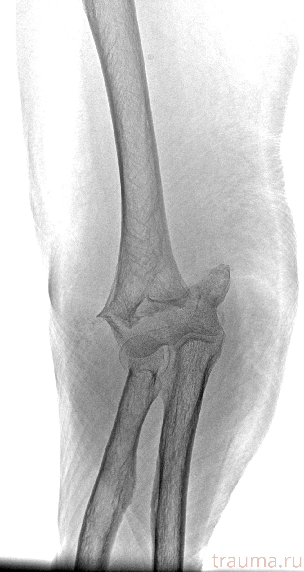 Рентген на дому: по вашему адресу приезжает врач-рентгенолог, травматолог-ортопед с мобильным рентгеновским аппаратом, проводит диагностику травмы или заболевания, делает необходимые рентгенограммы, дает рекомендации по дальнейшему лечению. Получить качественные снимки в домашних условиях возможно благодаря уникальной методике, разработанной МосРентген Центром для института  Склифосовского