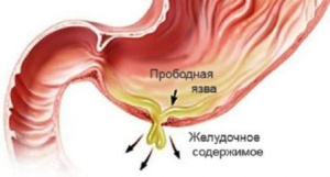 Курс медицинской рентгенологии.Рентгенологическое исследование органов пищеварения (пищевода, желудка, кишечника, желчного аппарата) и диафрагмы.Часть 2. Глава 9.6
Курс медицинской рентгенологии.Рентгенологическое исследование органов пищеварения (пищевода, желудка, кишечника, желчного аппарата) и диафрагмы.Часть 2. Глава 9.6