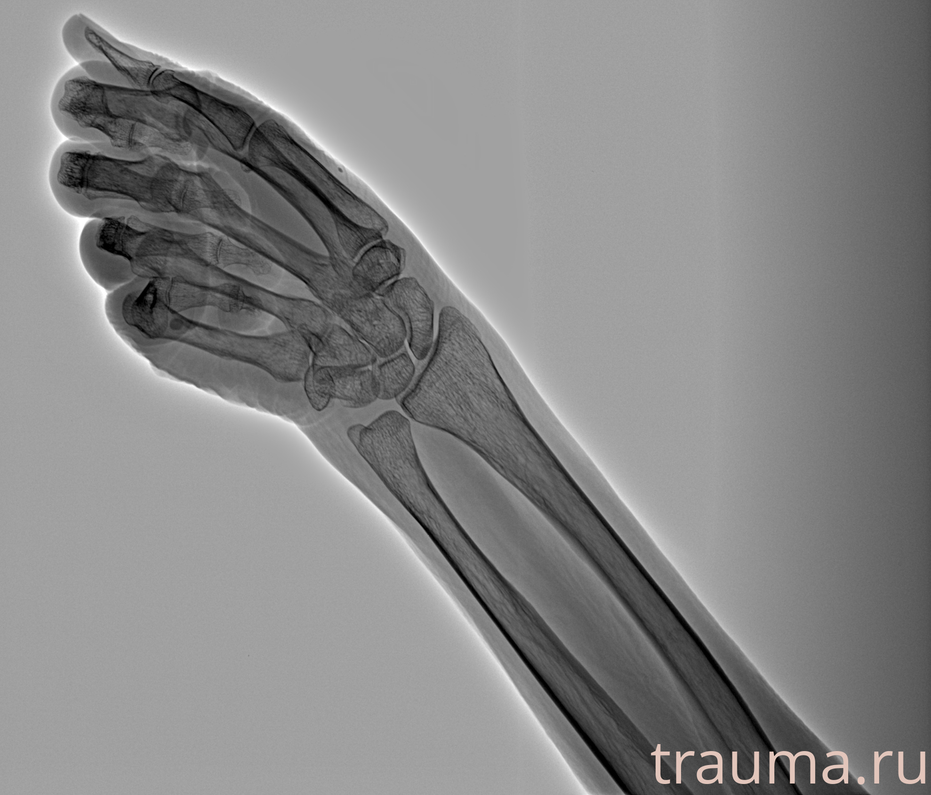 Рентген на дому: по вашему адресу приезжает врач-рентгенолог, травматолог-ортопед с мобильным рентгеновским аппаратом, проводит диагностику травмы или заболевания, делает необходимые рентгенограммы, дает рекомендации по дальнейшему лечению. Получить качественные снимки в домашних условиях возможно благодаря уникальной методике, разработанной МосРентген Центром для института  Склифосовского