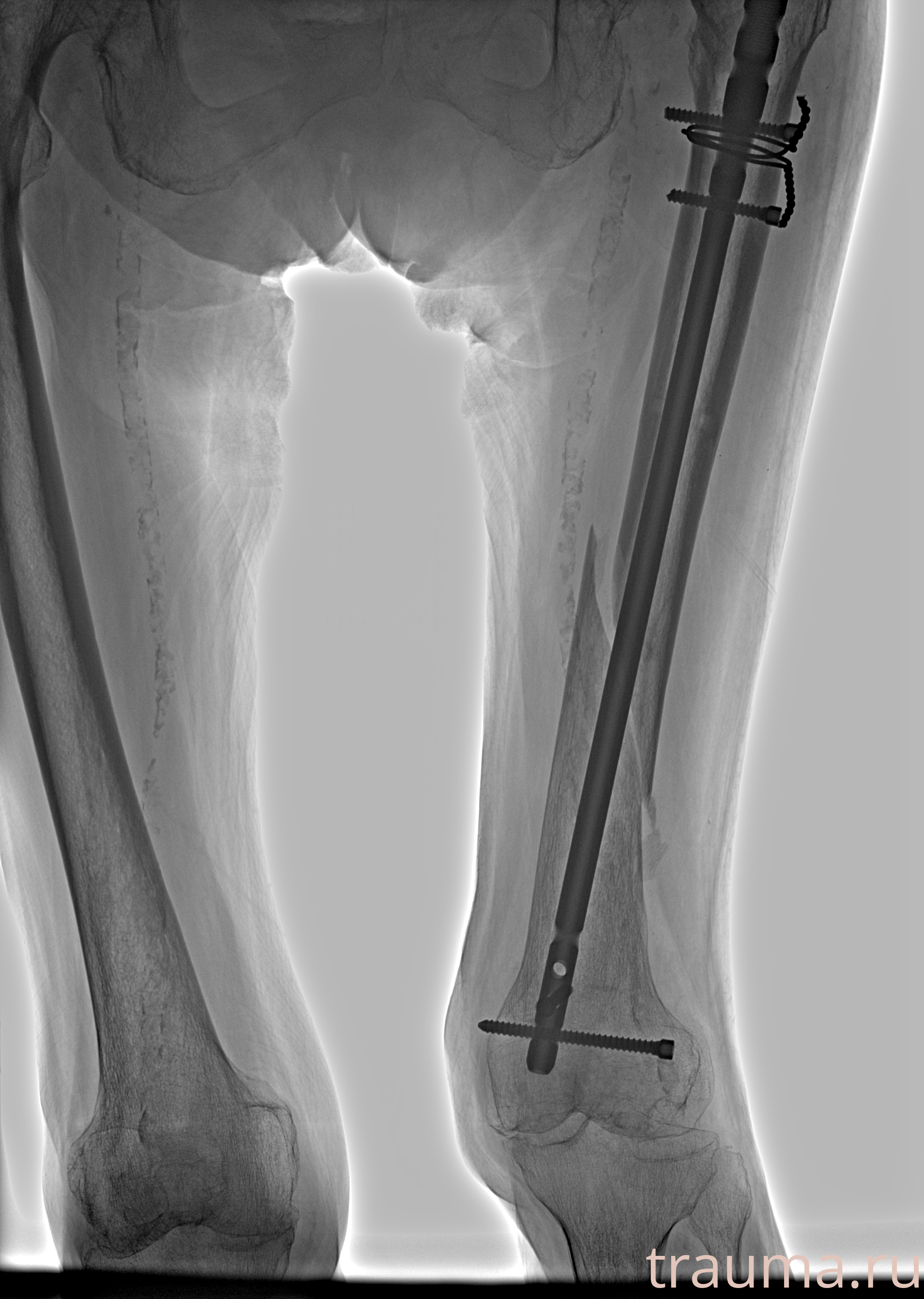 Рентген на дому: по вашему адресу приезжает врач-рентгенолог, травматолог-ортопед с мобильным рентгеновским аппаратом, проводит диагностику травмы или заболевания, делает необходимые рентгенограммы, дает рекомендации по дальнейшему лечению. Получить качественные снимки в домашних условиях возможно благодаря уникальной методике, разработанной МосРентген Центром для института  Склифосовского