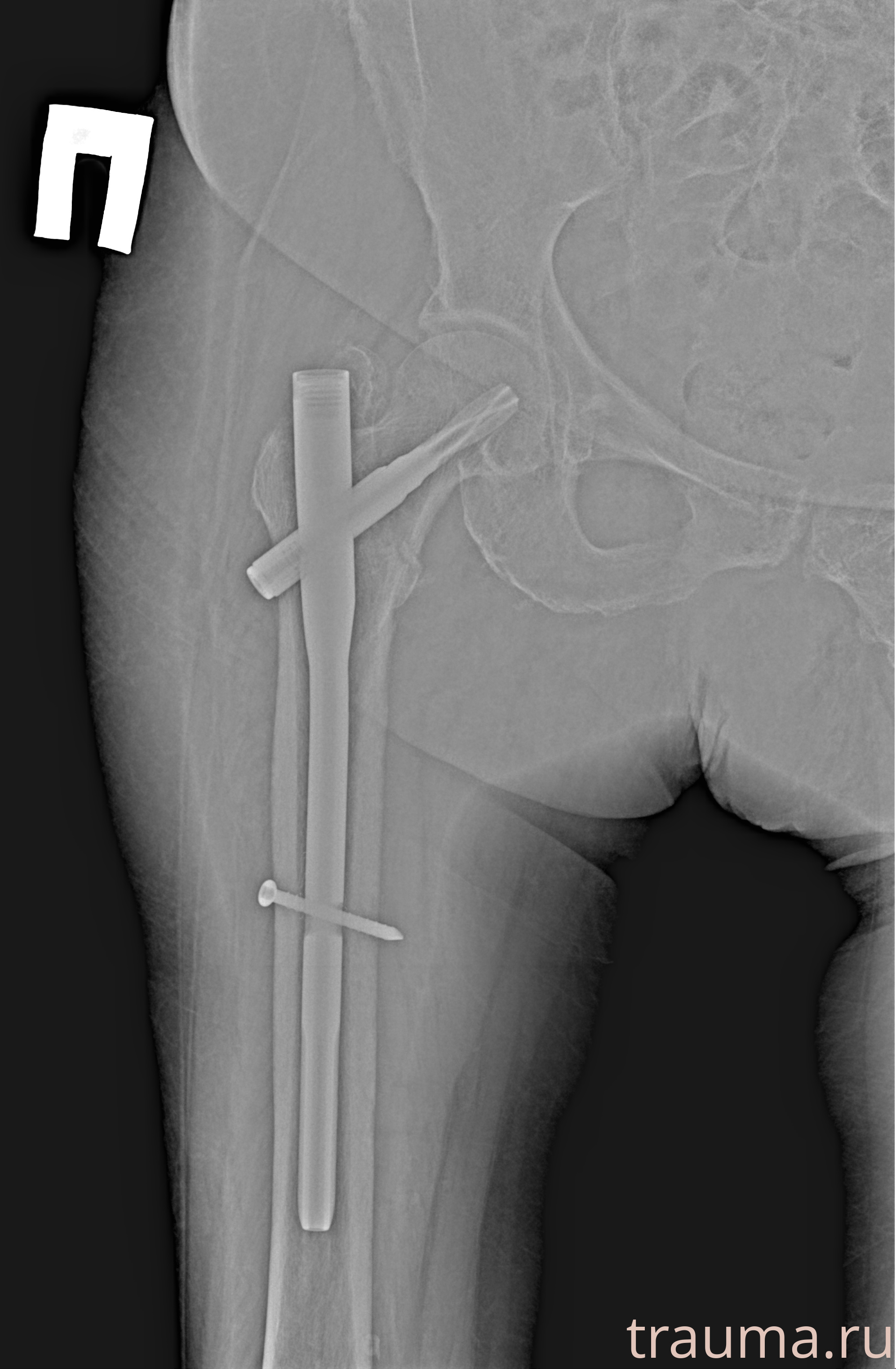 Рентген на дому: по вашему адресу приезжает врач-рентгенолог, травматолог-ортопед с мобильным рентгеновским аппаратом, проводит диагностику травмы или заболевания, делает необходимые рентгенограммы, дает рекомендации по дальнейшему лечению. Получить качественные снимки в домашних условиях возможно благодаря уникальной методике, разработанной МосРентген Центром для института  Склифосовского