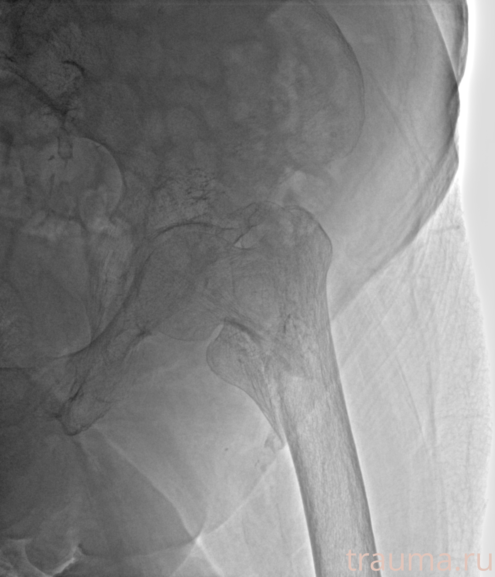 Рентген на дому: по вашему адресу приезжает врач-рентгенолог, травматолог-ортопед с мобильным рентгеновским аппаратом, проводит диагностику травмы или заболевания, делает необходимые рентгенограммы, дает рекомендации по дальнейшему лечению. Получить качественные снимки в домашних условиях возможно благодаря уникальной методике, разработанной МосРентген Центром для института  Склифосовского