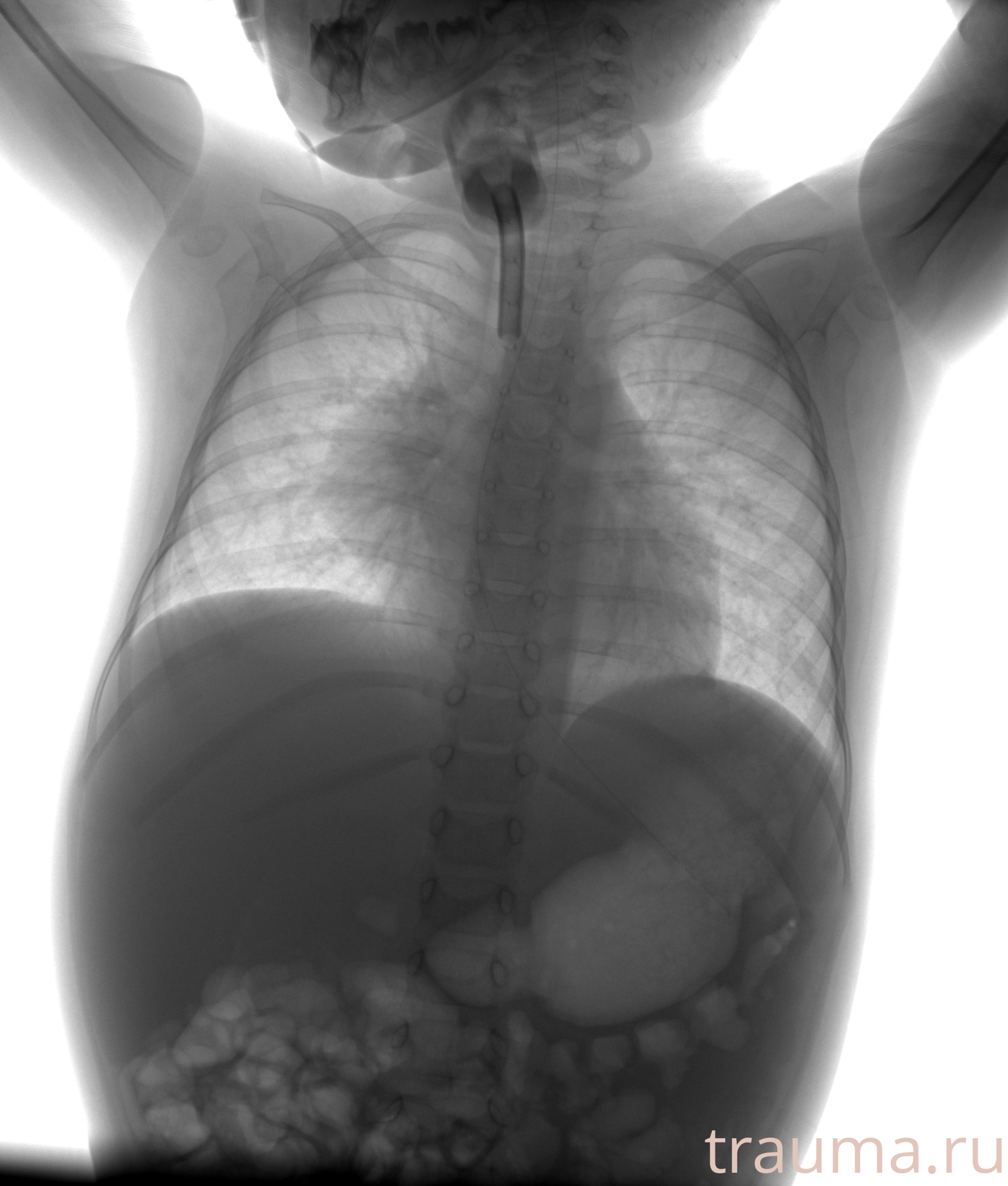 Рентген на дому: по вашему адресу приезжает врач-рентгенолог, травматолог-ортопед с мобильным рентгеновским аппаратом, проводит диагностику травмы или заболевания, делает необходимые рентгенограммы, дает рекомендации по дальнейшему лечению. Получить качественные снимки в домашних условиях возможно благодаря уникальной методике, разработанной МосРентген Центром для института  Склифосовского