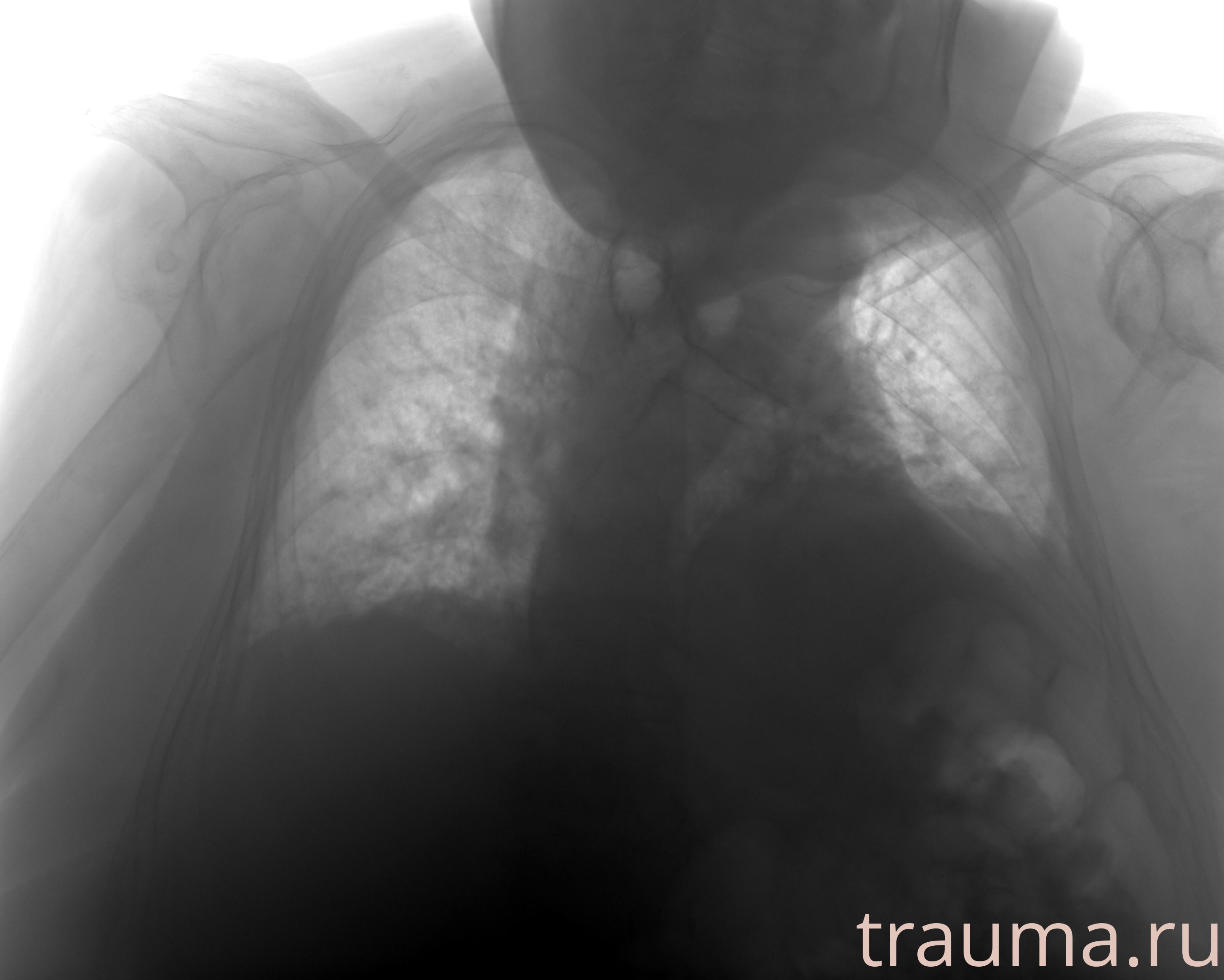 Рентген на дому: по вашему адресу приезжает врач-рентгенолог, травматолог-ортопед с мобильным рентгеновским аппаратом, проводит диагностику травмы или заболевания, делает необходимые рентгенограммы, дает рекомендации по дальнейшему лечению. Получить качественные снимки в домашних условиях возможно благодаря уникальной методике, разработанной МосРентген Центром для института  Склифосовского