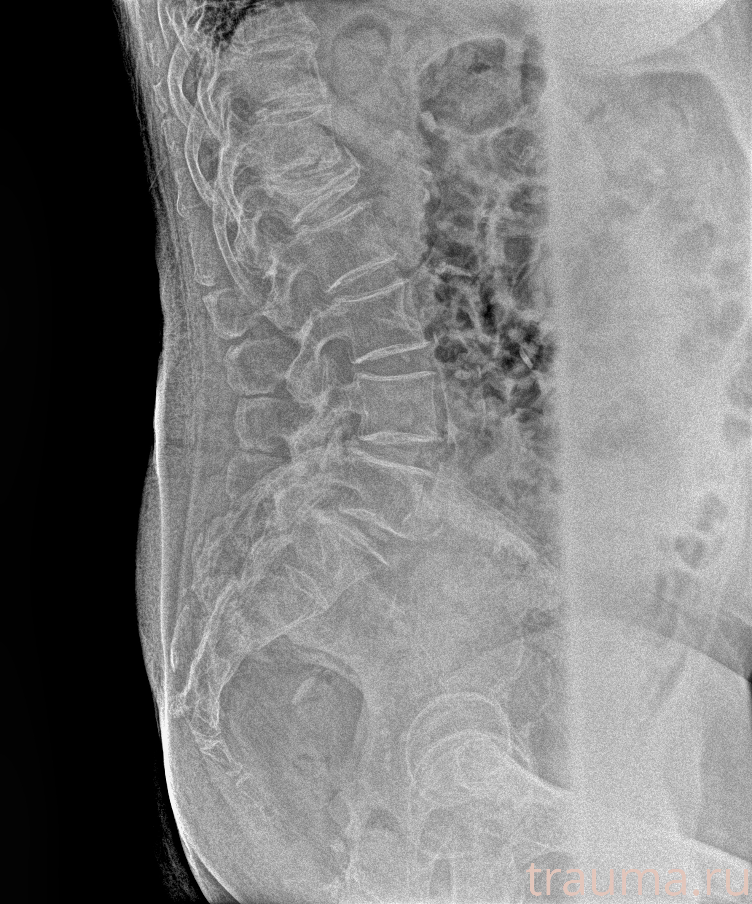 Рентген на дому: по вашему адресу приезжает врач-рентгенолог, травматолог-ортопед с мобильным рентгеновским аппаратом, проводит диагностику травмы или заболевания, делает необходимые рентгенограммы, дает рекомендации по дальнейшему лечению. Получить качественные снимки в домашних условиях возможно благодаря уникальной методике, разработанной МосРентген Центром для института  Склифосовского