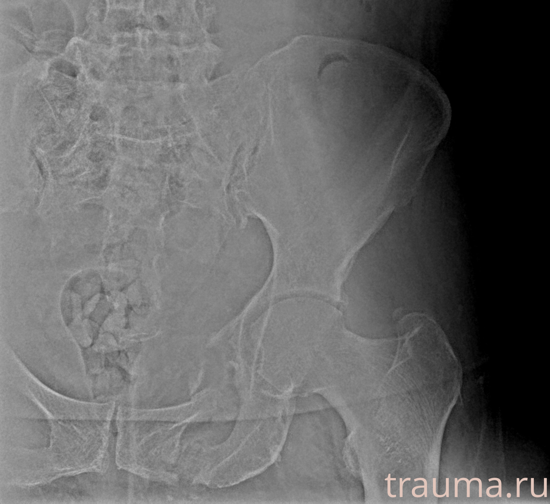 Рентген на дому: по вашему адресу приезжает врач-рентгенолог, травматолог-ортопед с мобильным рентгеновским аппаратом, проводит диагностику травмы или заболевания, делает необходимые рентгенограммы, дает рекомендации по дальнейшему лечению. Получить качественные снимки в домашних условиях возможно благодаря уникальной методике, разработанной МосРентген Центром для института  Склифосовского