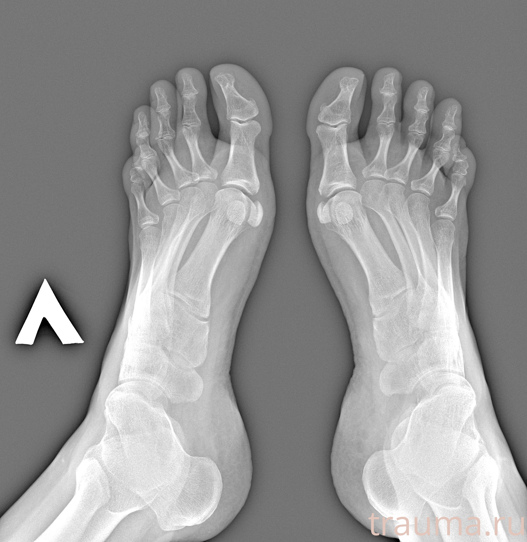 Рентген на дому: по вашему адресу приезжает врач-рентгенолог, травматолог-ортопед с мобильным рентгеновским аппаратом, проводит диагностику травмы или заболевания, делает необходимые рентгенограммы, дает рекомендации по дальнейшему лечению. Получить качественные снимки в домашних условиях возможно благодаря уникальной методике, разработанной МосРентген Центром для института  Склифосовского