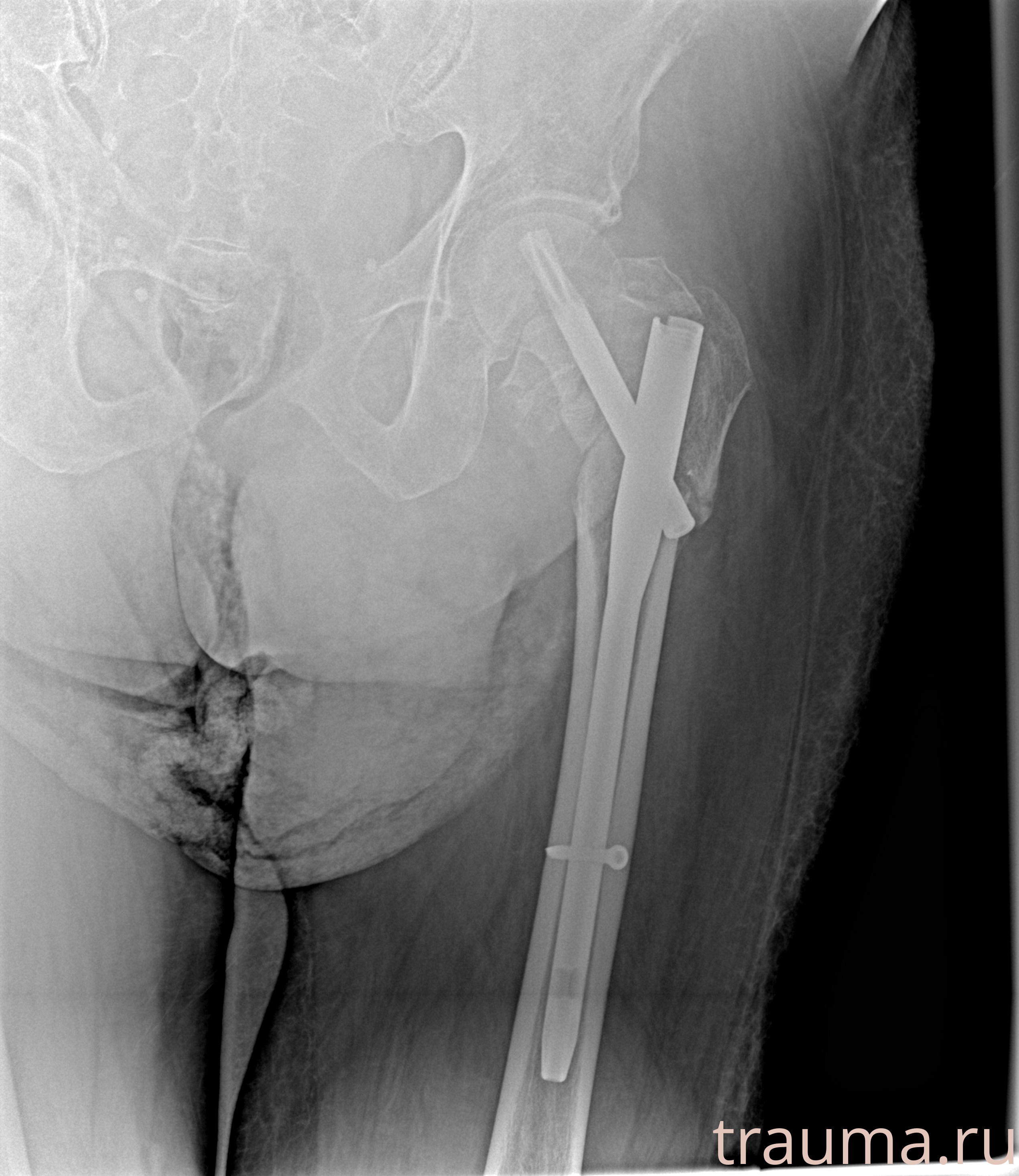 Рентген на дому: по вашему адресу приезжает врач-рентгенолог, травматолог-ортопед с мобильным рентгеновским аппаратом, проводит диагностику травмы или заболевания, делает необходимые рентгенограммы, дает рекомендации по дальнейшему лечению. Получить качественные снимки в домашних условиях возможно благодаря уникальной методике, разработанной МосРентген Центром для института  Склифосовского