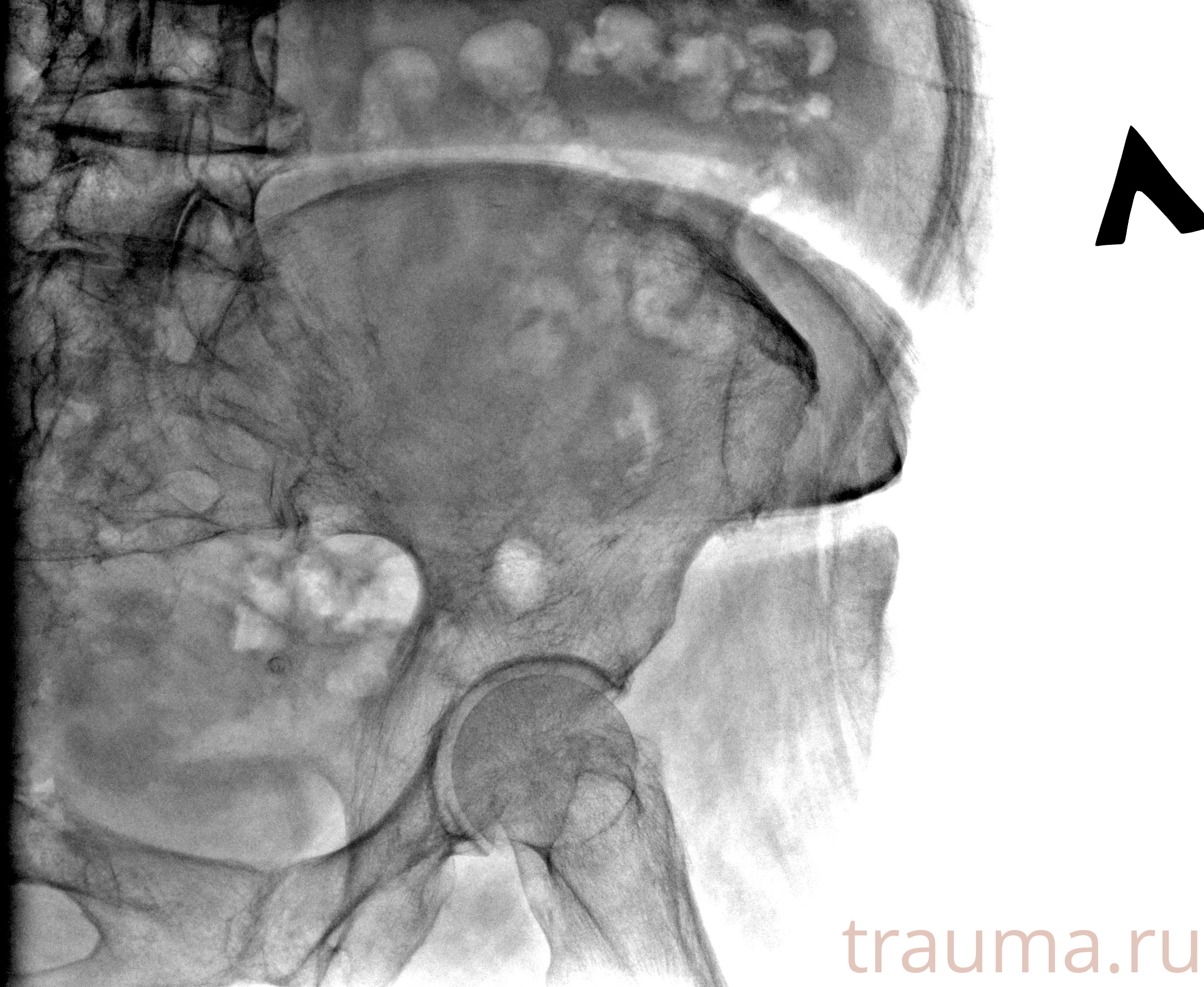 Рентген на дому: по вашему адресу приезжает врач-рентгенолог, травматолог-ортопед с мобильным рентгеновским аппаратом, проводит диагностику травмы или заболевания, делает необходимые рентгенограммы, дает рекомендации по дальнейшему лечению. Получить качественные снимки в домашних условиях возможно благодаря уникальной методике, разработанной МосРентген Центром для института  Склифосовского