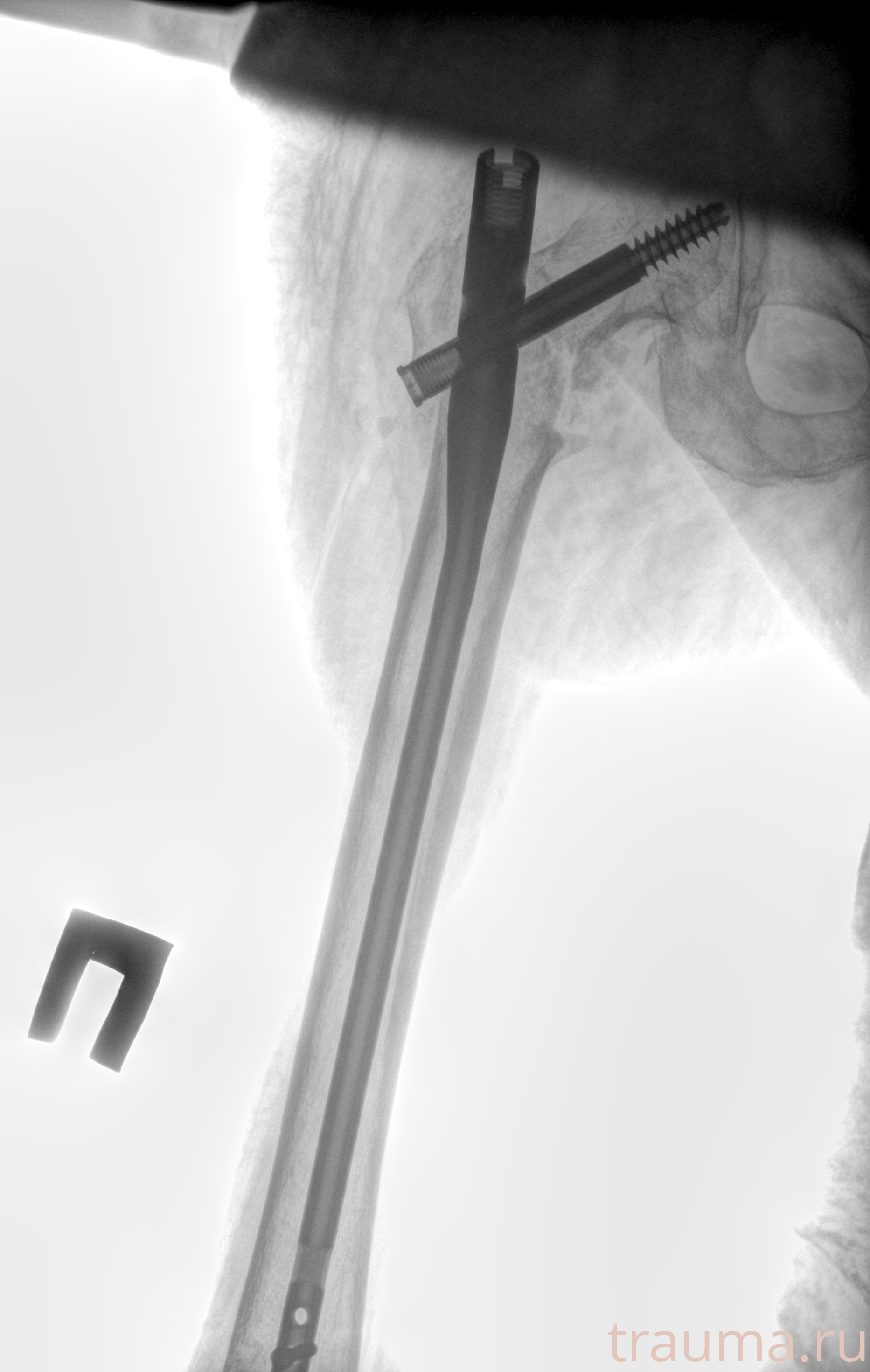 Рентген на дому: по вашему адресу приезжает врач-рентгенолог, травматолог-ортопед с мобильным рентгеновским аппаратом, проводит диагностику травмы или заболевания, делает необходимые рентгенограммы, дает рекомендации по дальнейшему лечению. Получить качественные снимки в домашних условиях возможно благодаря уникальной методике, разработанной МосРентген Центром для института  Склифосовского