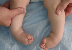 Клинико-физиологический подход к диагностике и лечению врожденной косолапости у детей до 5 лет