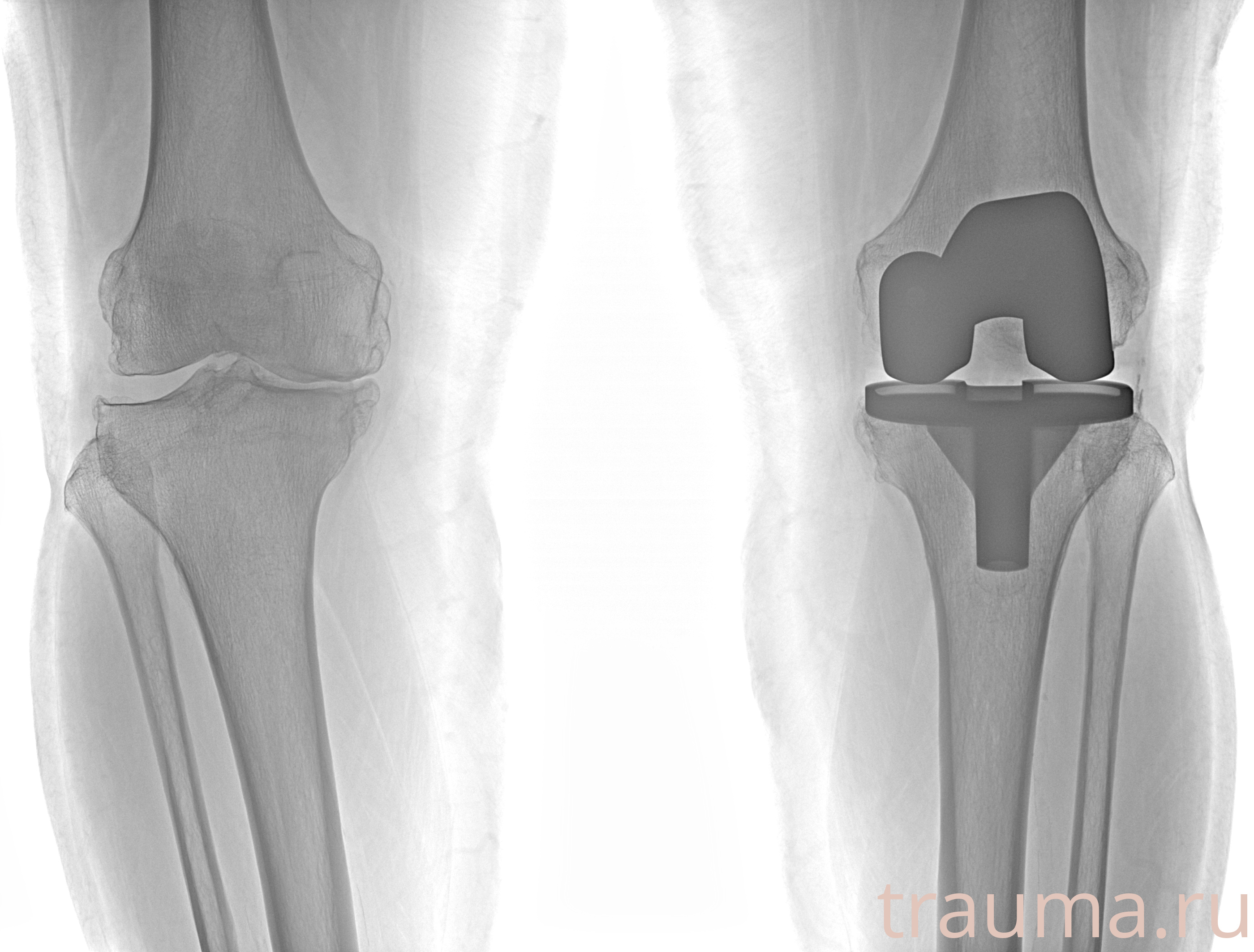 Рентген на дому: по вашему адресу приезжает врач-рентгенолог, травматолог-ортопед с мобильным рентгеновским аппаратом, проводит диагностику травмы или заболевания, делает необходимые рентгенограммы, дает рекомендации по дальнейшему лечению. Получить качественные снимки в домашних условиях возможно благодаря уникальной методике, разработанной МосРентген Центром для института  Склифосовского