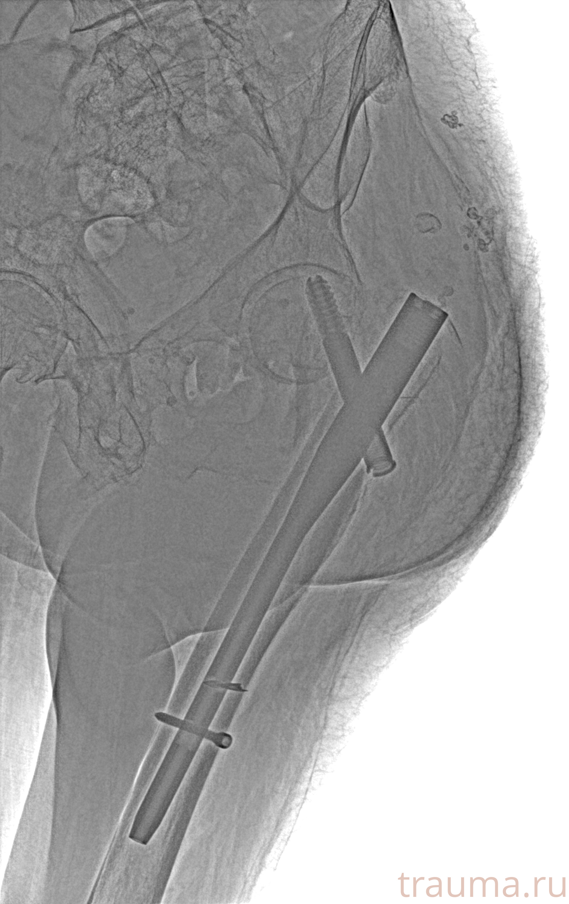 Рентген на дому: по вашему адресу приезжает врач-рентгенолог, травматолог-ортопед с мобильным рентгеновским аппаратом, проводит диагностику травмы или заболевания, делает необходимые рентгенограммы, дает рекомендации по дальнейшему лечению. Получить качественные снимки в домашних условиях возможно благодаря уникальной методике, разработанной МосРентген Центром для института  Склифосовского