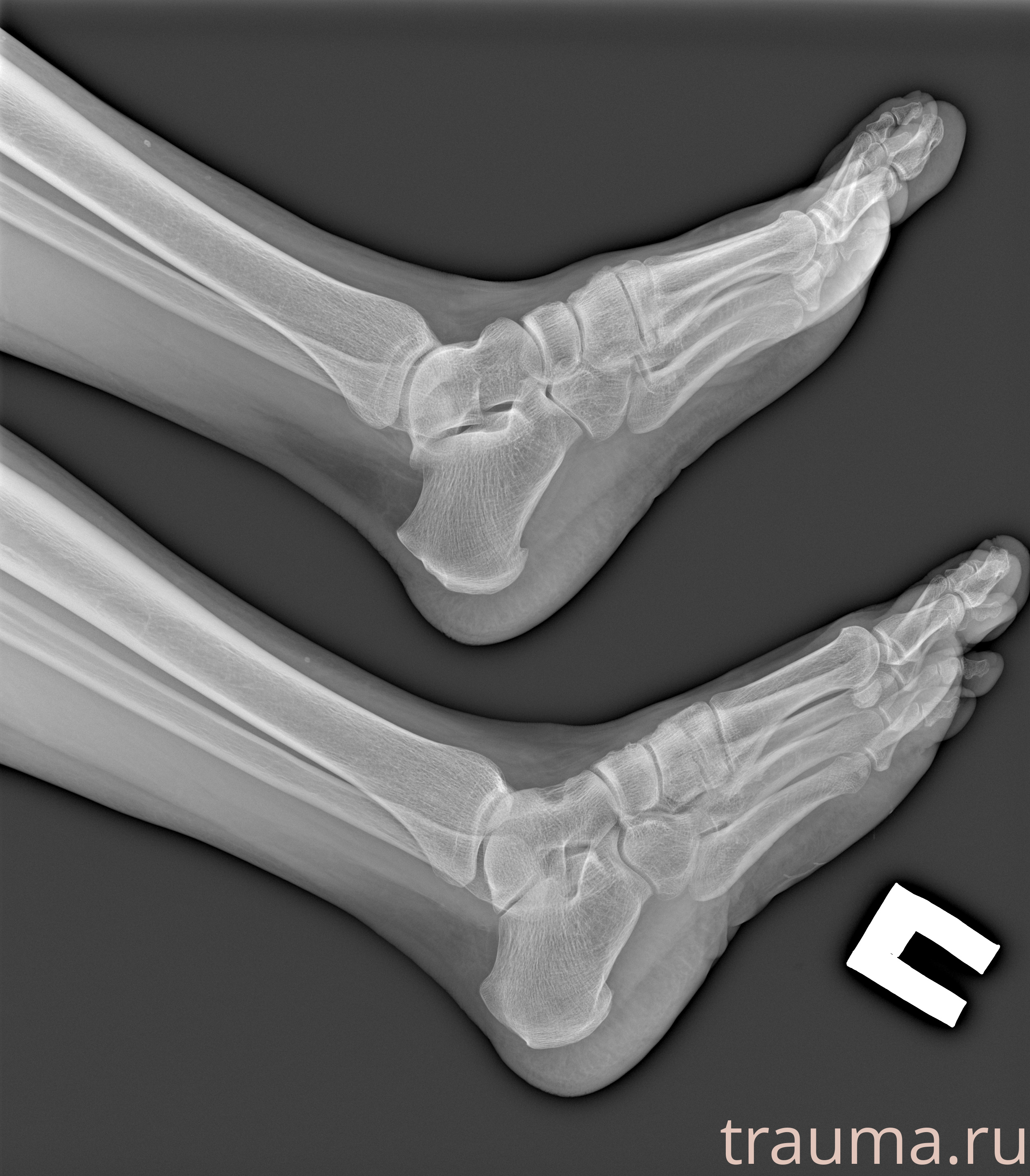 Рентген на дому: по вашему адресу приезжает врач-рентгенолог, травматолог-ортопед с мобильным рентгеновским аппаратом, проводит диагностику травмы или заболевания, делает необходимые рентгенограммы, дает рекомендации по дальнейшему лечению. Получить качественные снимки в домашних условиях возможно благодаря уникальной методике, разработанной МосРентген Центром для института  Склифосовского
