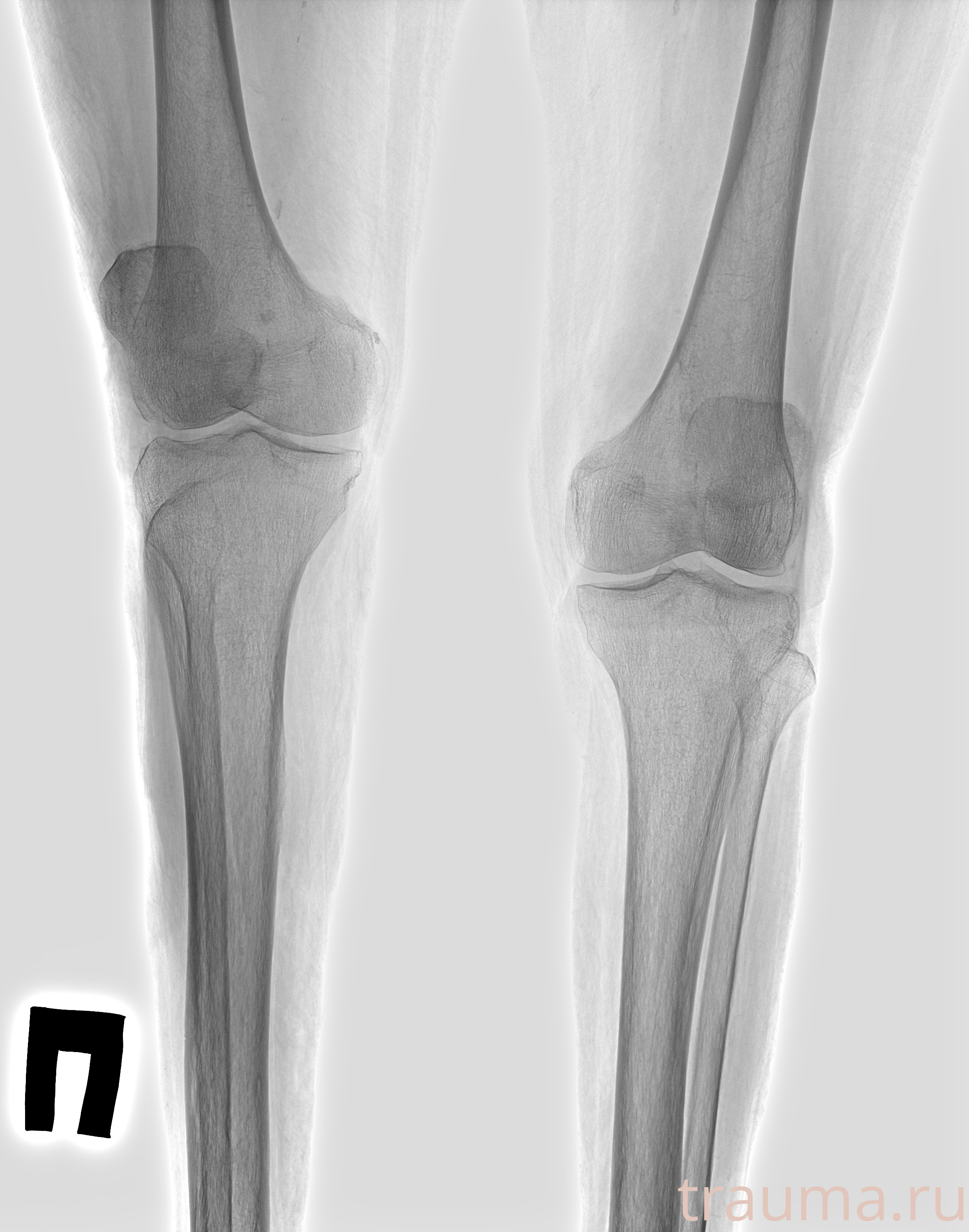 Рентген на дому: по вашему адресу приезжает врач-рентгенолог, травматолог-ортопед с мобильным рентгеновским аппаратом, проводит диагностику травмы или заболевания, делает необходимые рентгенограммы, дает рекомендации по дальнейшему лечению. Получить качественные снимки в домашних условиях возможно благодаря уникальной методике, разработанной МосРентген Центром для института  Склифосовского