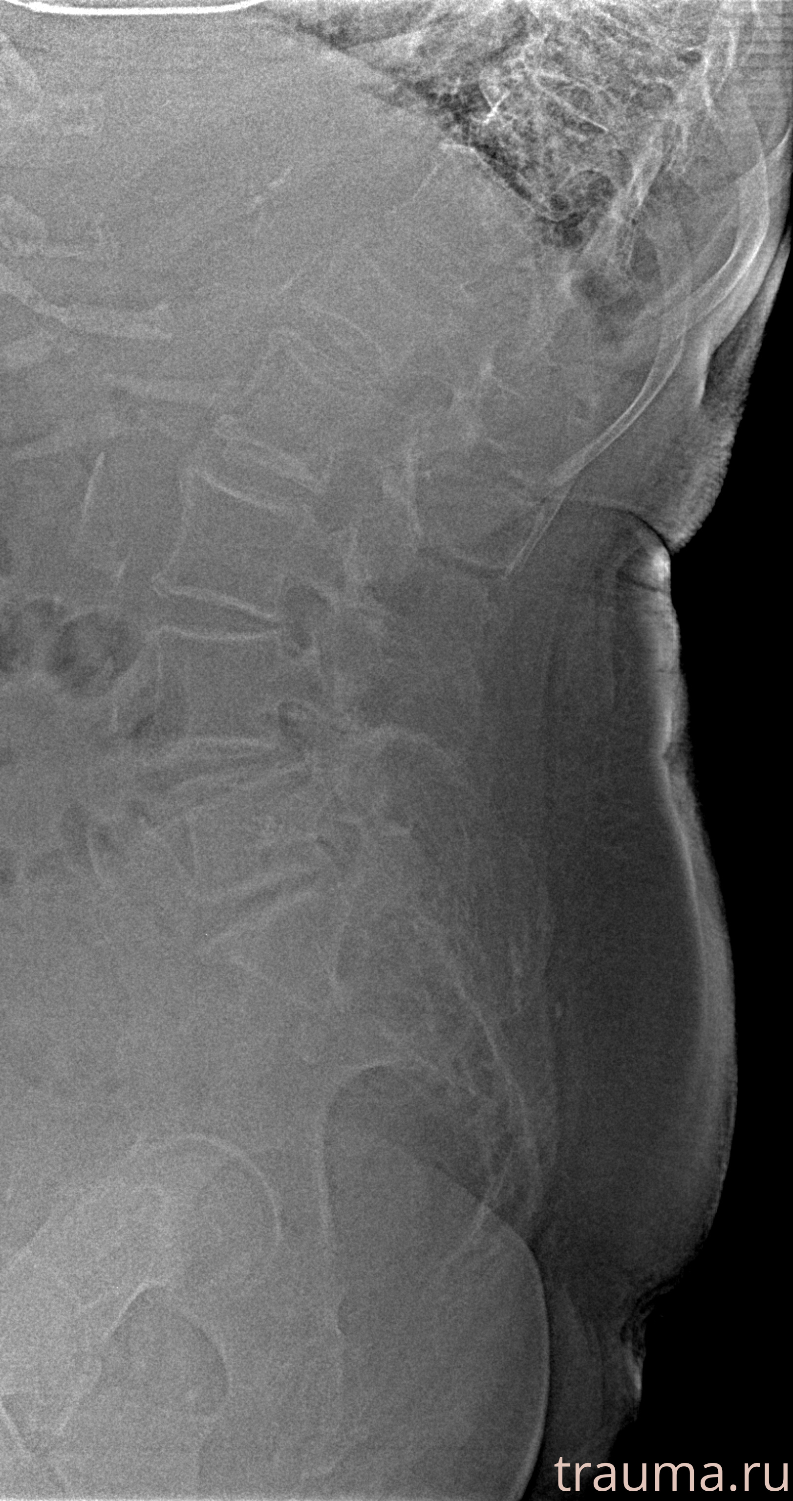 Рентген на дому: по вашему адресу приезжает врач-рентгенолог, травматолог-ортопед с мобильным рентгеновским аппаратом, проводит диагностику травмы или заболевания, делает необходимые рентгенограммы, дает рекомендации по дальнейшему лечению. Получить качественные снимки в домашних условиях возможно благодаря уникальной методике, разработанной МосРентген Центром для института  Склифосовского