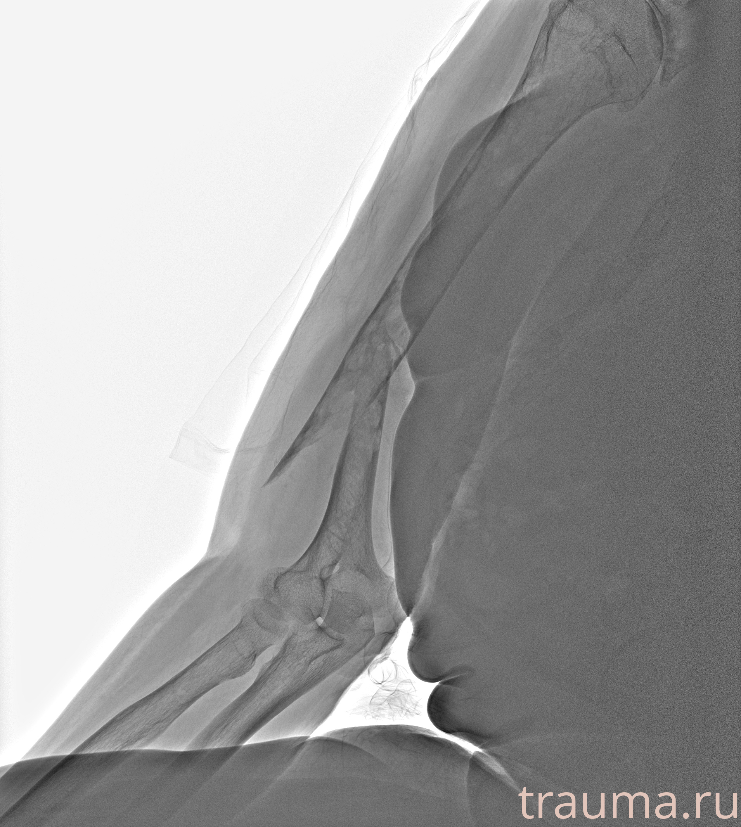 Рентген на дому: по вашему адресу приезжает врач-рентгенолог, травматолог-ортопед с мобильным рентгеновским аппаратом, проводит диагностику травмы или заболевания, делает необходимые рентгенограммы, дает рекомендации по дальнейшему лечению. Получить качественные снимки в домашних условиях возможно благодаря уникальной методике, разработанной МосРентген Центром для института  Склифосовского