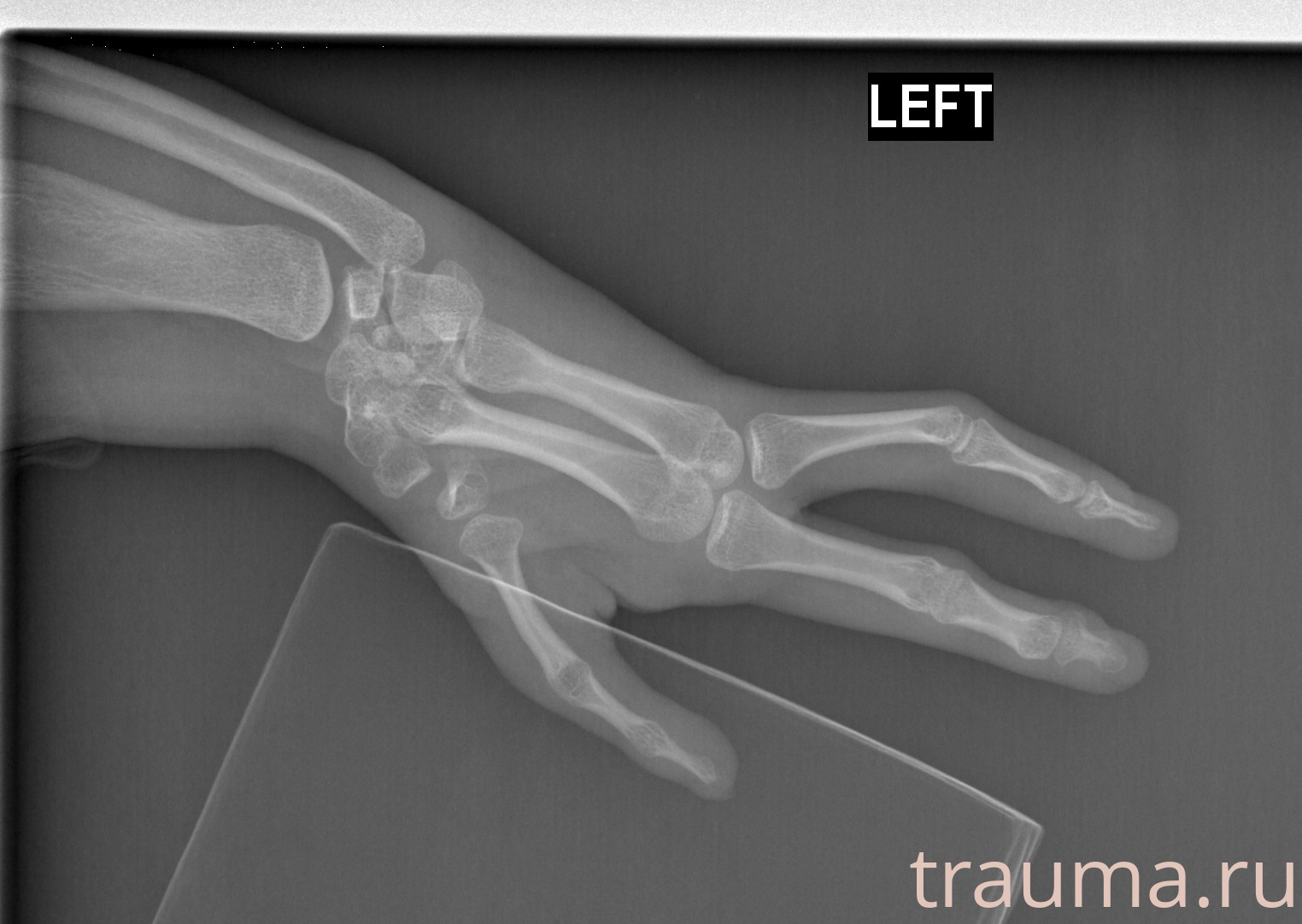 Рентген на дому: по вашему адресу приезжает врач-рентгенолог, травматолог-ортопед с мобильным рентгеновским аппаратом, проводит диагностику травмы или заболевания, делает необходимые рентгенограммы, дает рекомендации по дальнейшему лечению. Получить качественные снимки в домашних условиях возможно благодаря уникальной методике, разработанной МосРентген Центром для института  Склифосовского