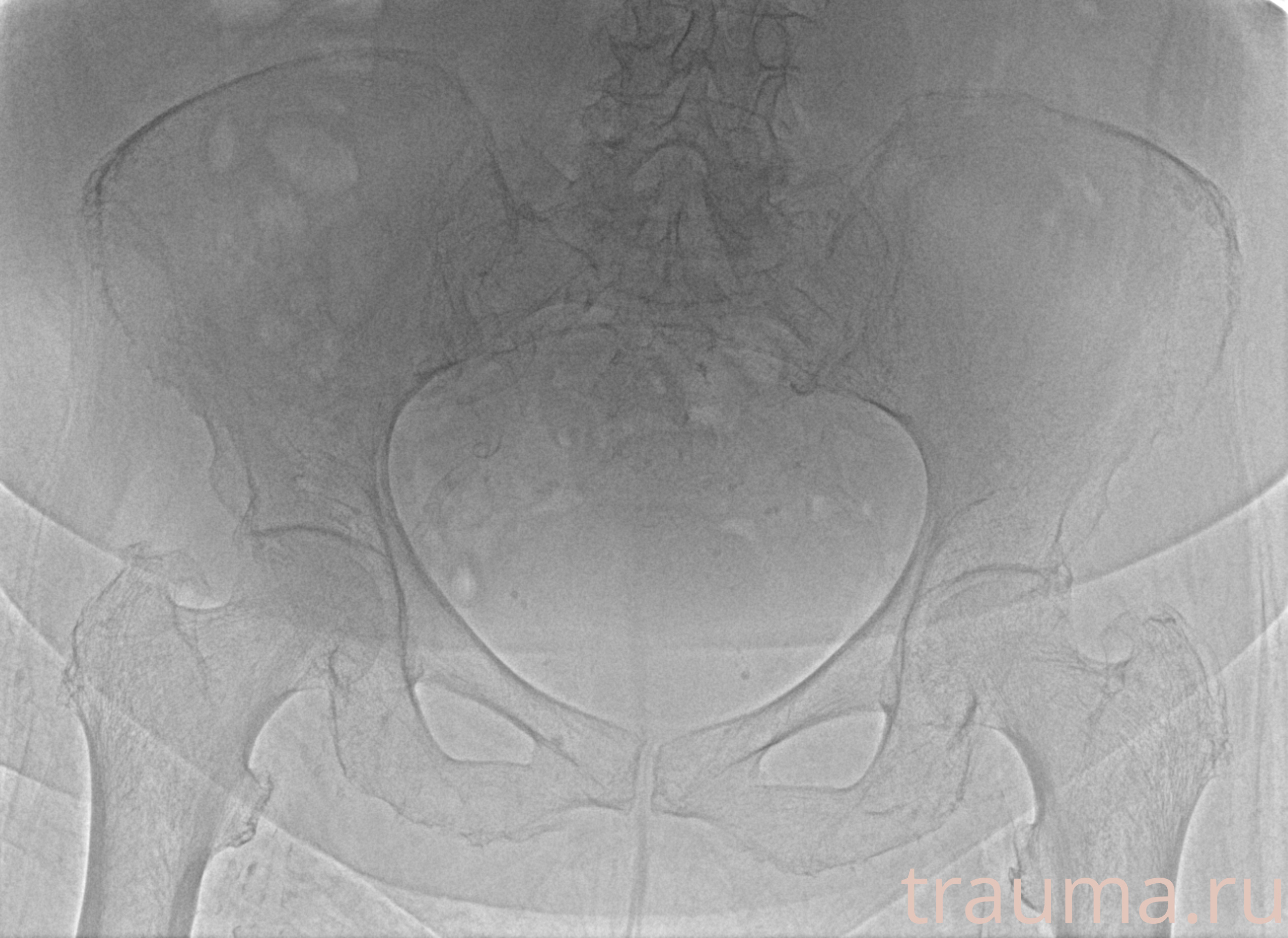 Рентген на дому: по вашему адресу приезжает врач-рентгенолог, травматолог-ортопед с мобильным рентгеновским аппаратом, проводит диагностику травмы или заболевания, делает необходимые рентгенограммы, дает рекомендации по дальнейшему лечению. Получить качественные снимки в домашних условиях возможно благодаря уникальной методике, разработанной МосРентген Центром для института  Склифосовского