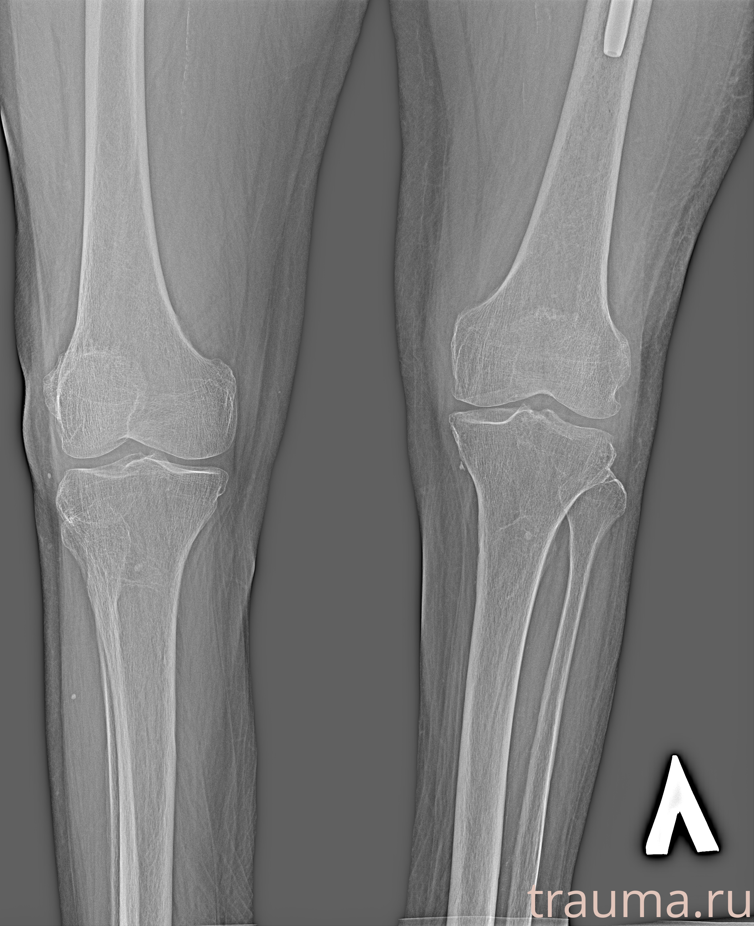 Рентген на дому: по вашему адресу приезжает врач-рентгенолог, травматолог-ортопед с мобильным рентгеновским аппаратом, проводит диагностику травмы или заболевания, делает необходимые рентгенограммы, дает рекомендации по дальнейшему лечению. Получить качественные снимки в домашних условиях возможно благодаря уникальной методике, разработанной МосРентген Центром для института  Склифосовского