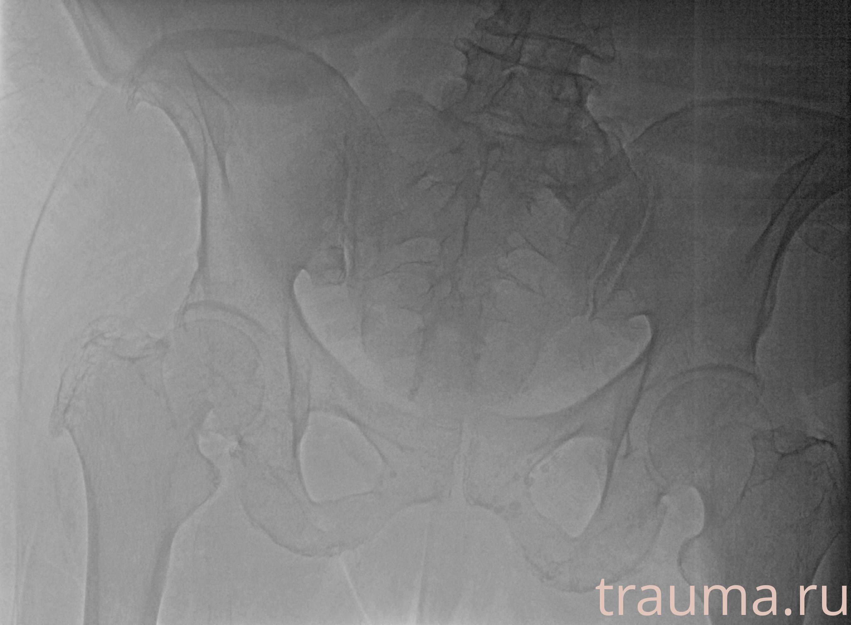 Рентген на дому: по вашему адресу приезжает врач-рентгенолог, травматолог-ортопед с мобильным рентгеновским аппаратом, проводит диагностику травмы или заболевания, делает необходимые рентгенограммы, дает рекомендации по дальнейшему лечению. Получить качественные снимки в домашних условиях возможно благодаря уникальной методике, разработанной МосРентген Центром для института  Склифосовского