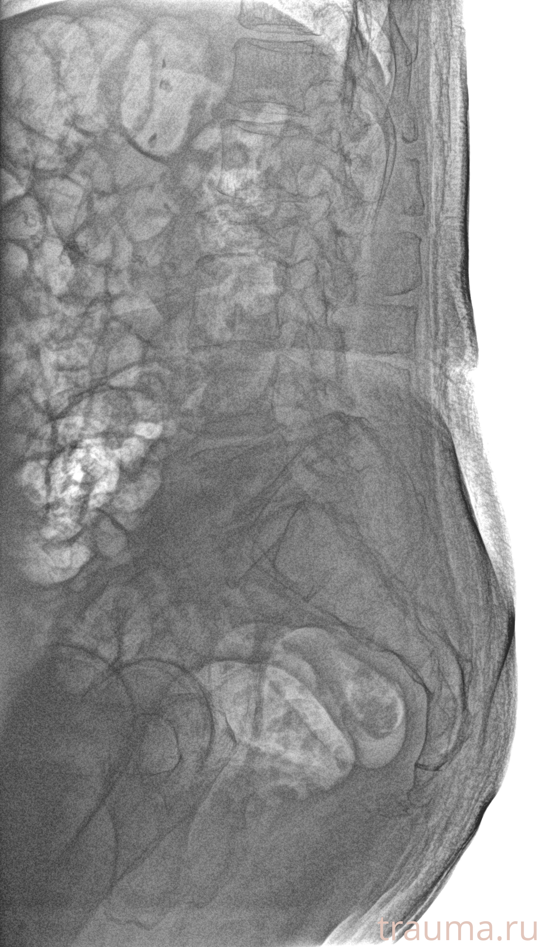 Рентген на дому: по вашему адресу приезжает врач-рентгенолог, травматолог-ортопед с мобильным рентгеновским аппаратом, проводит диагностику травмы или заболевания, делает необходимые рентгенограммы, дает рекомендации по дальнейшему лечению. Получить качественные снимки в домашних условиях возможно благодаря уникальной методике, разработанной МосРентген Центром для института  Склифосовского