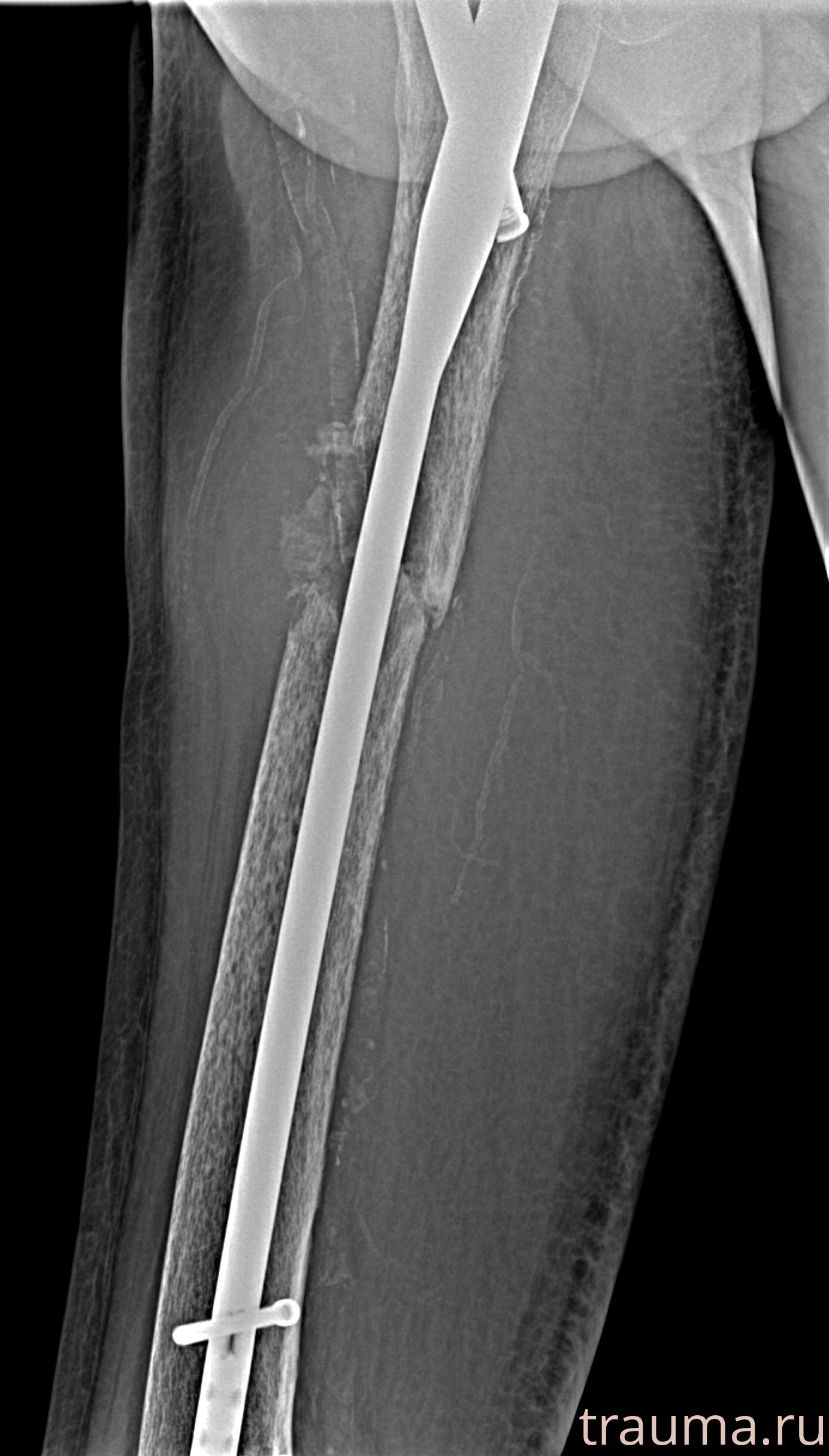 Рентген на дому: по вашему адресу приезжает врач-рентгенолог, травматолог-ортопед с мобильным рентгеновским аппаратом, проводит диагностику травмы или заболевания, делает необходимые рентгенограммы, дает рекомендации по дальнейшему лечению. Получить качественные снимки в домашних условиях возможно благодаря уникальной методике, разработанной МосРентген Центром для института  Склифосовского