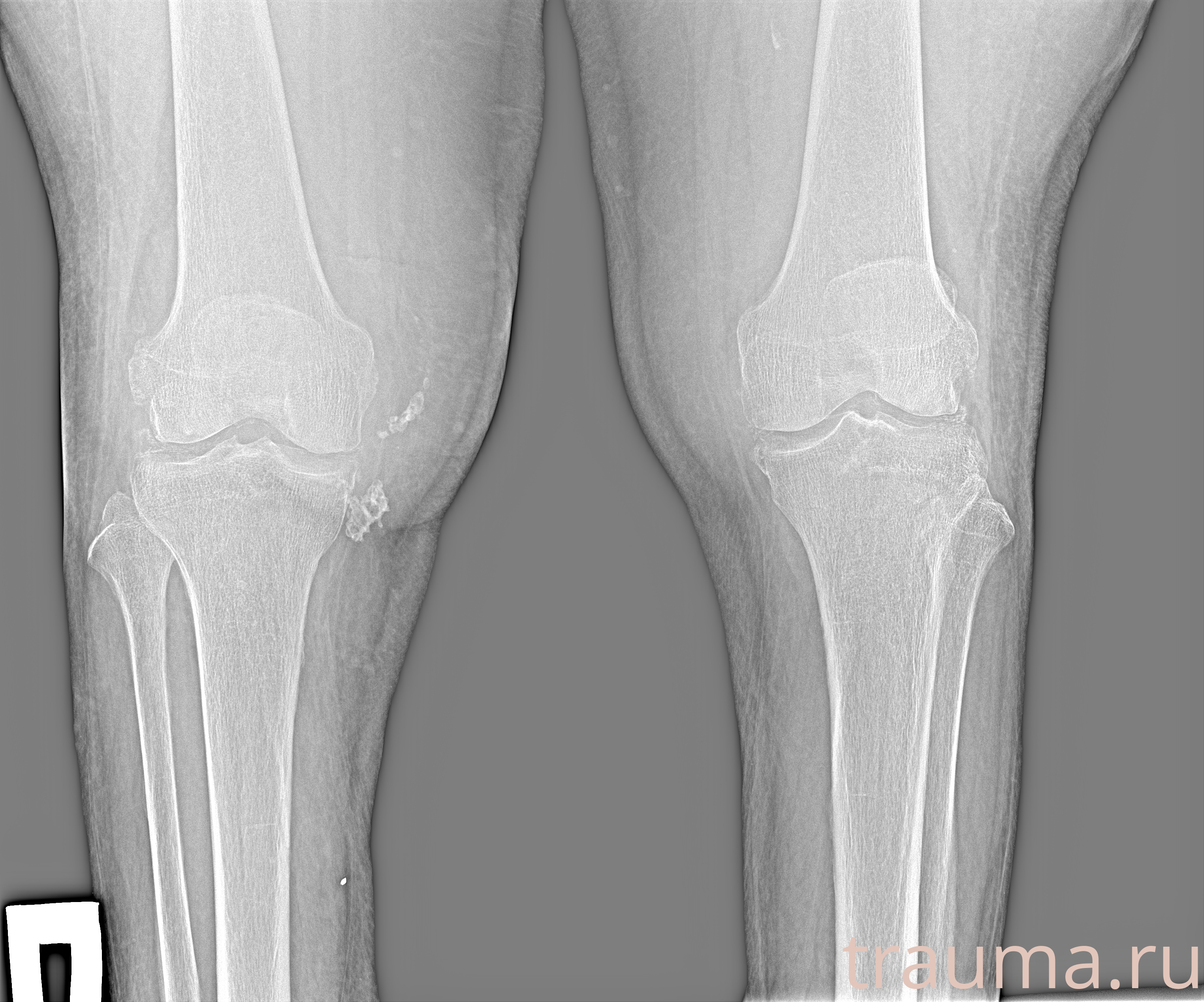 Рентген на дому: по вашему адресу приезжает врач-рентгенолог, травматолог-ортопед с мобильным рентгеновским аппаратом, проводит диагностику травмы или заболевания, делает необходимые рентгенограммы, дает рекомендации по дальнейшему лечению. Получить качественные снимки в домашних условиях возможно благодаря уникальной методике, разработанной МосРентген Центром для института  Склифосовского