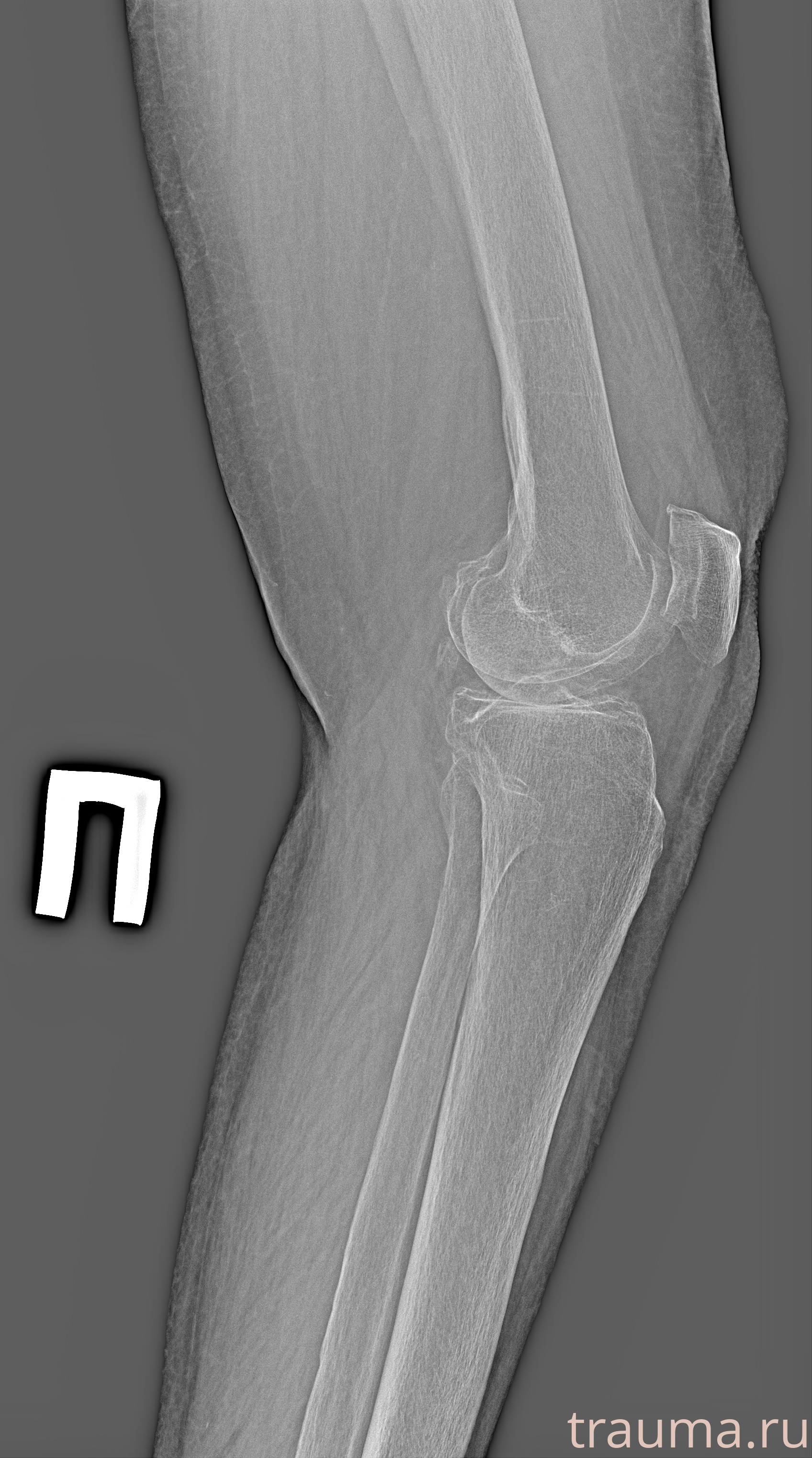 Рентген на дому: по вашему адресу приезжает врач-рентгенолог, травматолог-ортопед с мобильным рентгеновским аппаратом, проводит диагностику травмы или заболевания, делает необходимые рентгенограммы, дает рекомендации по дальнейшему лечению. Получить качественные снимки в домашних условиях возможно благодаря уникальной методике, разработанной МосРентген Центром для института  Склифосовского